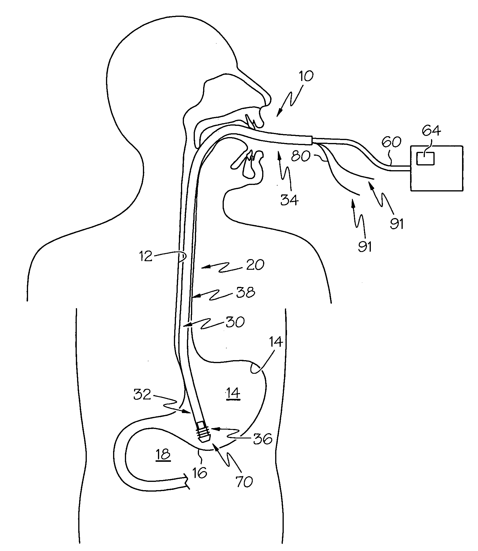 Detachable distal overtube section and methods for forming a sealable opening in the wall of an organ