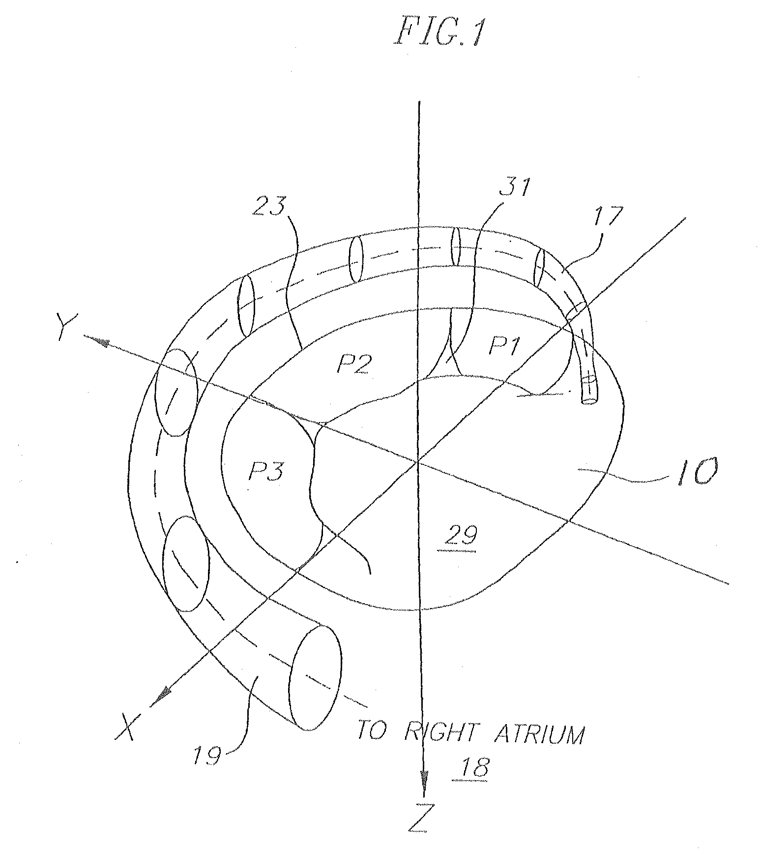 Medical implant with reinforcement mechanism