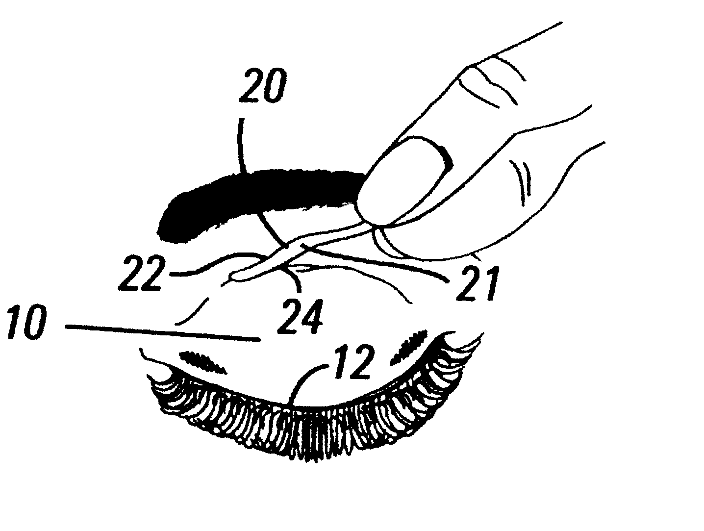 System for reducing eyelid droop