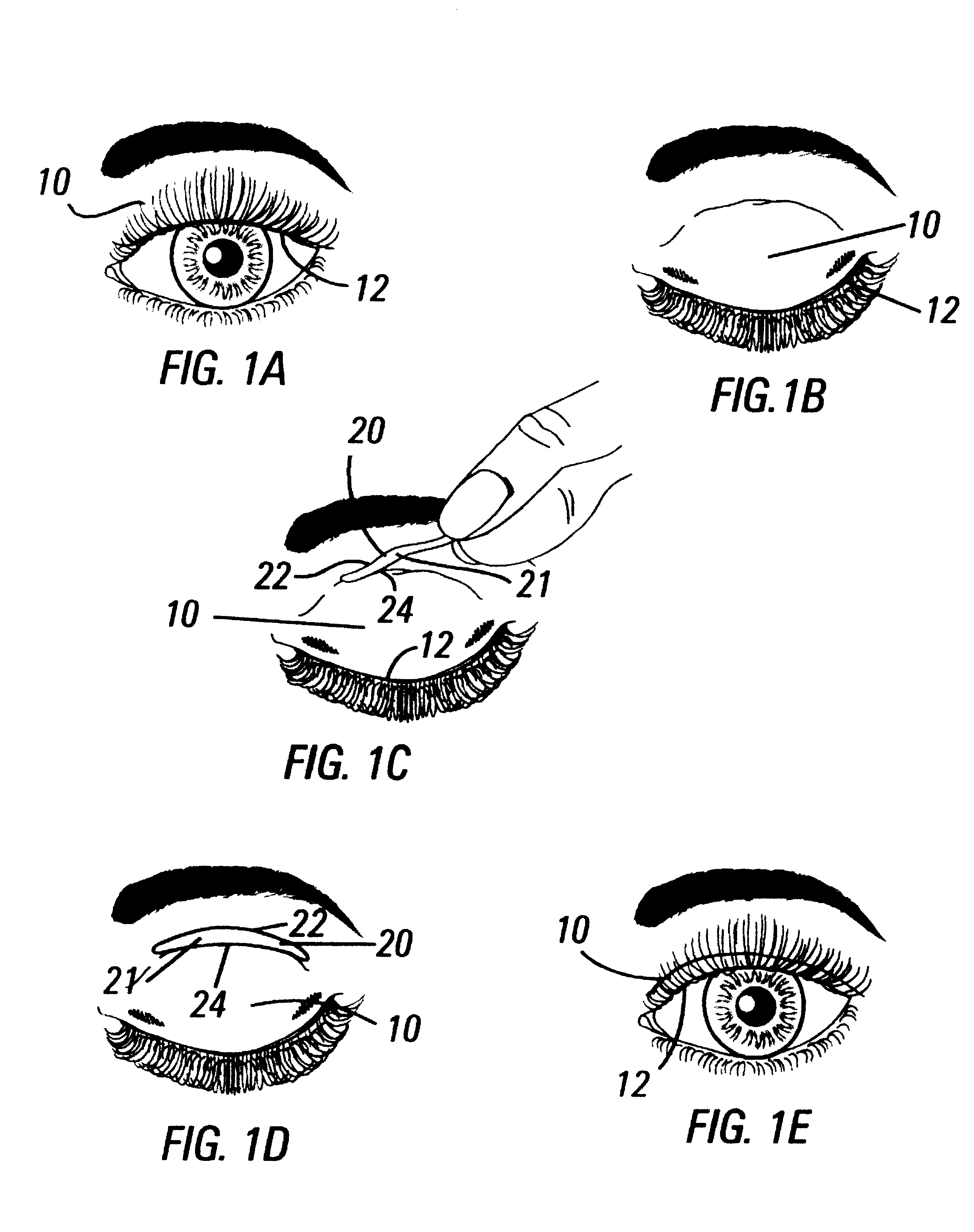 System for reducing eyelid droop
