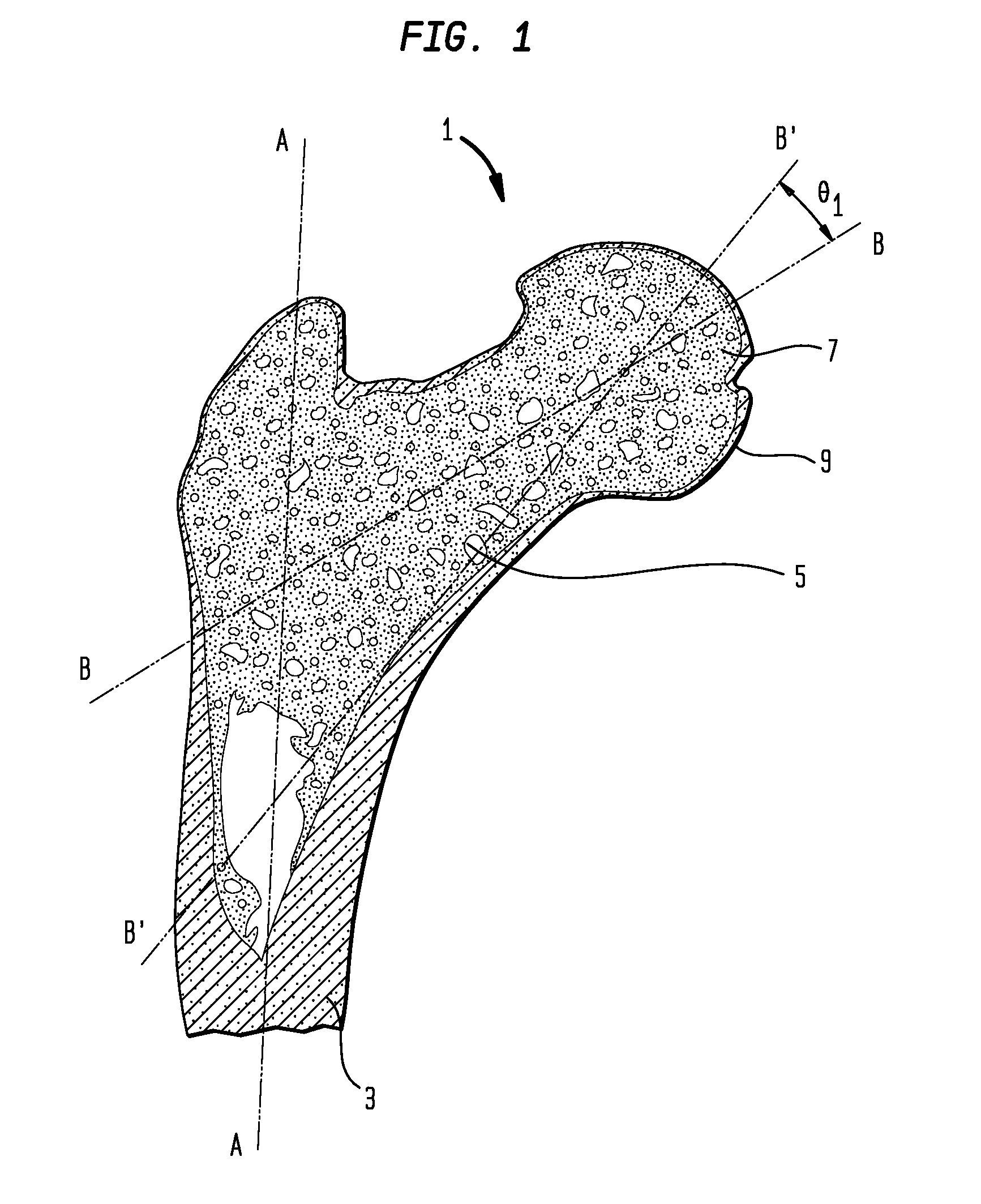 Method and apparatus for hip femoral resurfacing tooling