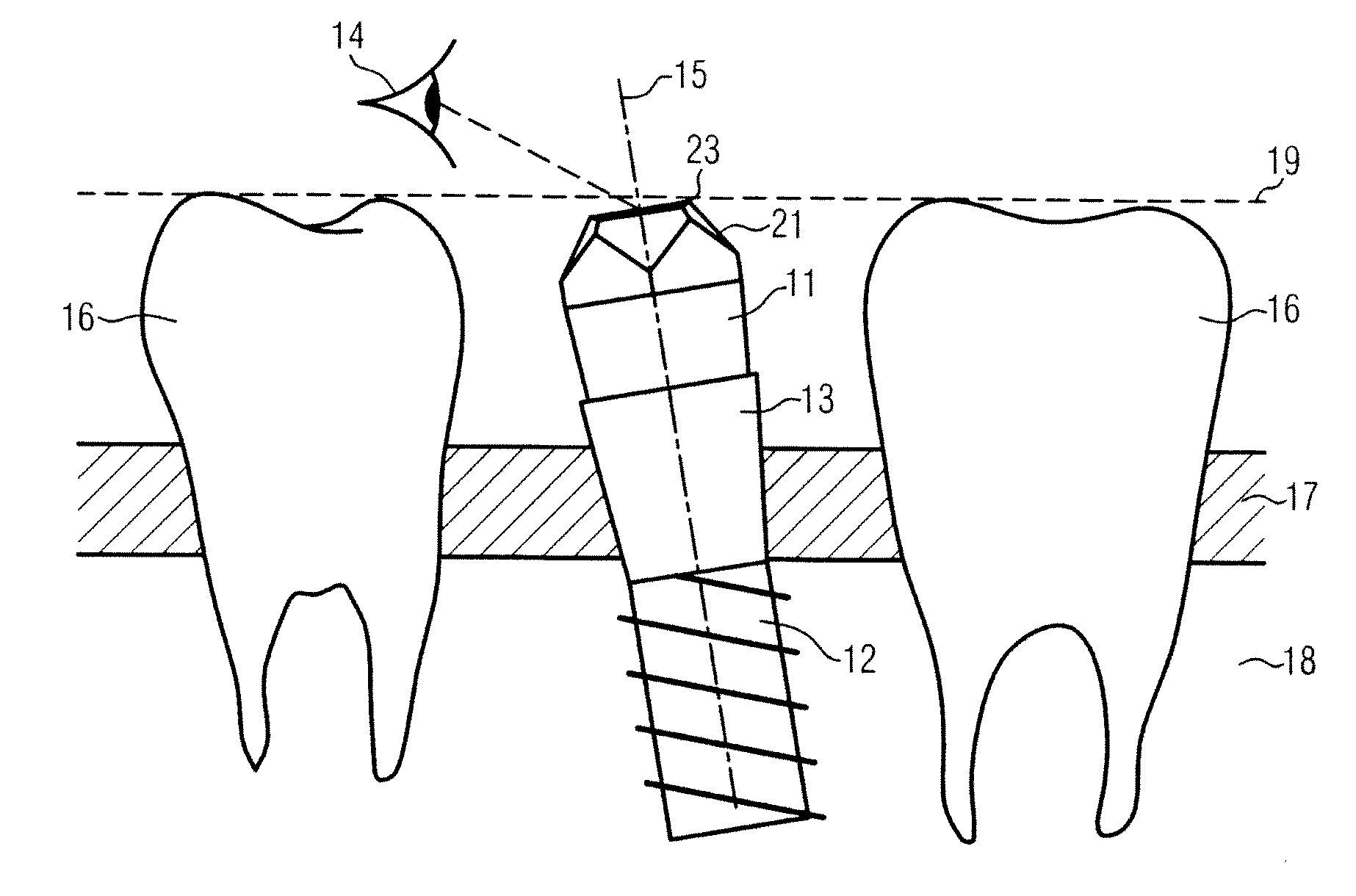 Determining position and orientation of a dental implant