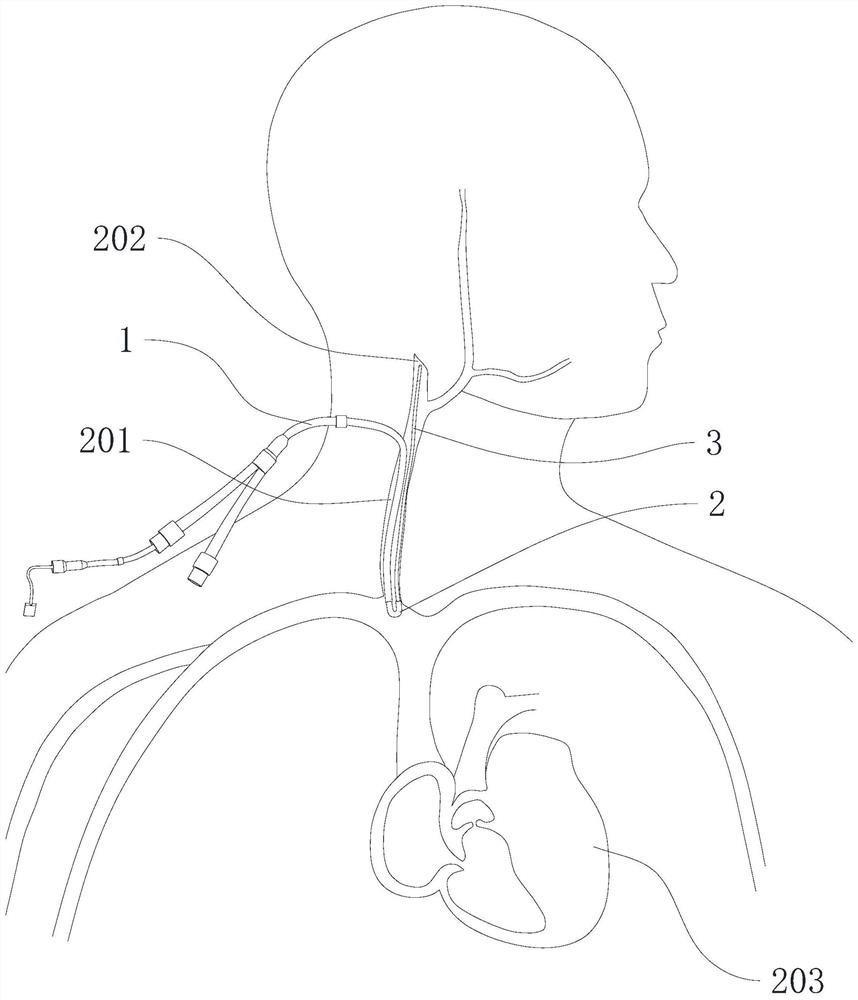 Blood vessel catheter placement method and jugular bulb oxygen saturation monitoring method