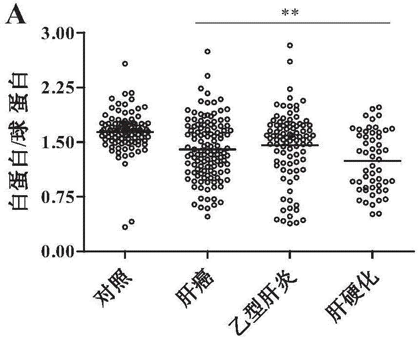 Method for diagnosing liver disease by utilizing property of serum capable of oxidizing sulfhydryls and kit
