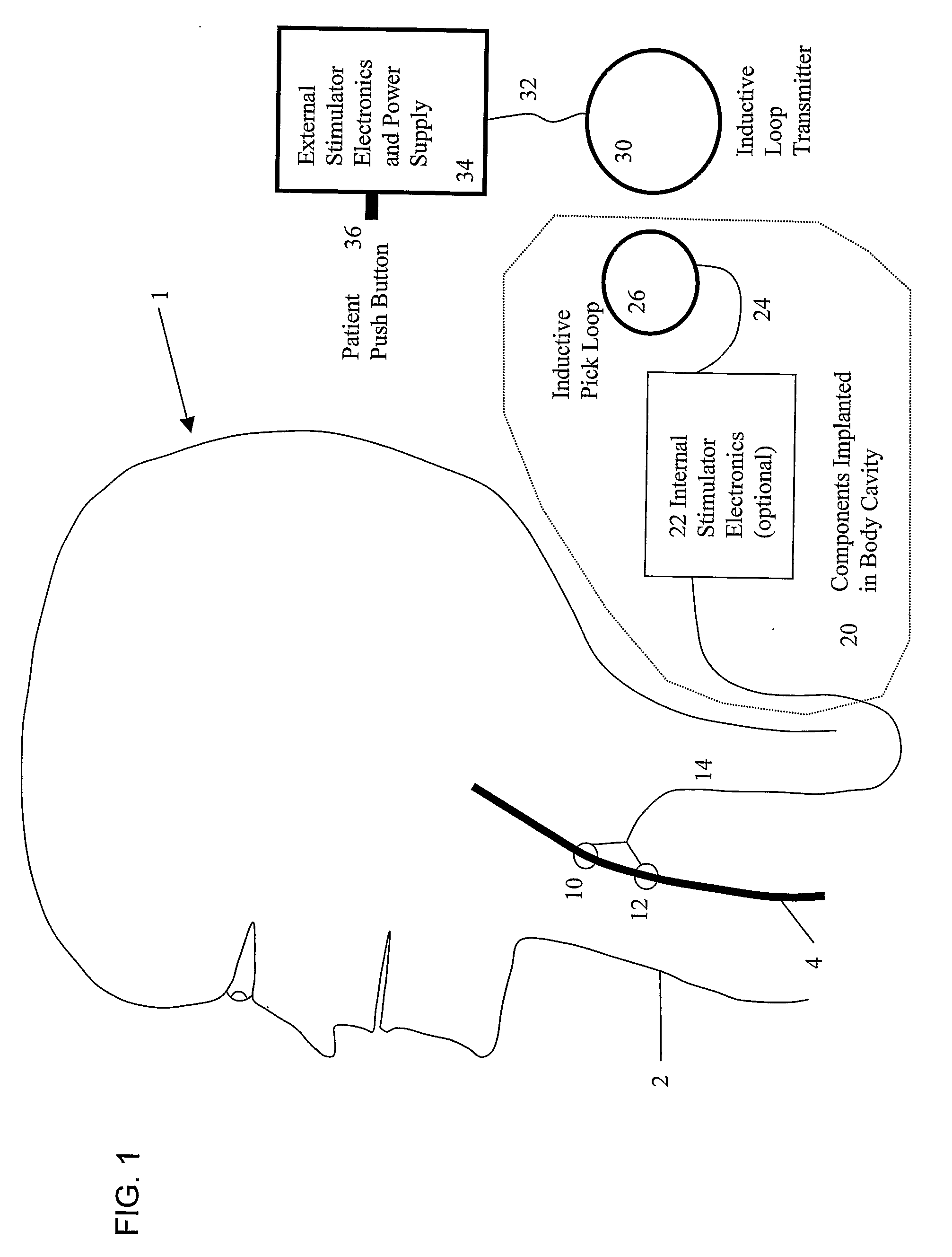 System and Method for Treating Nausea and Vomiting by Vagus Nerve Stimulation
