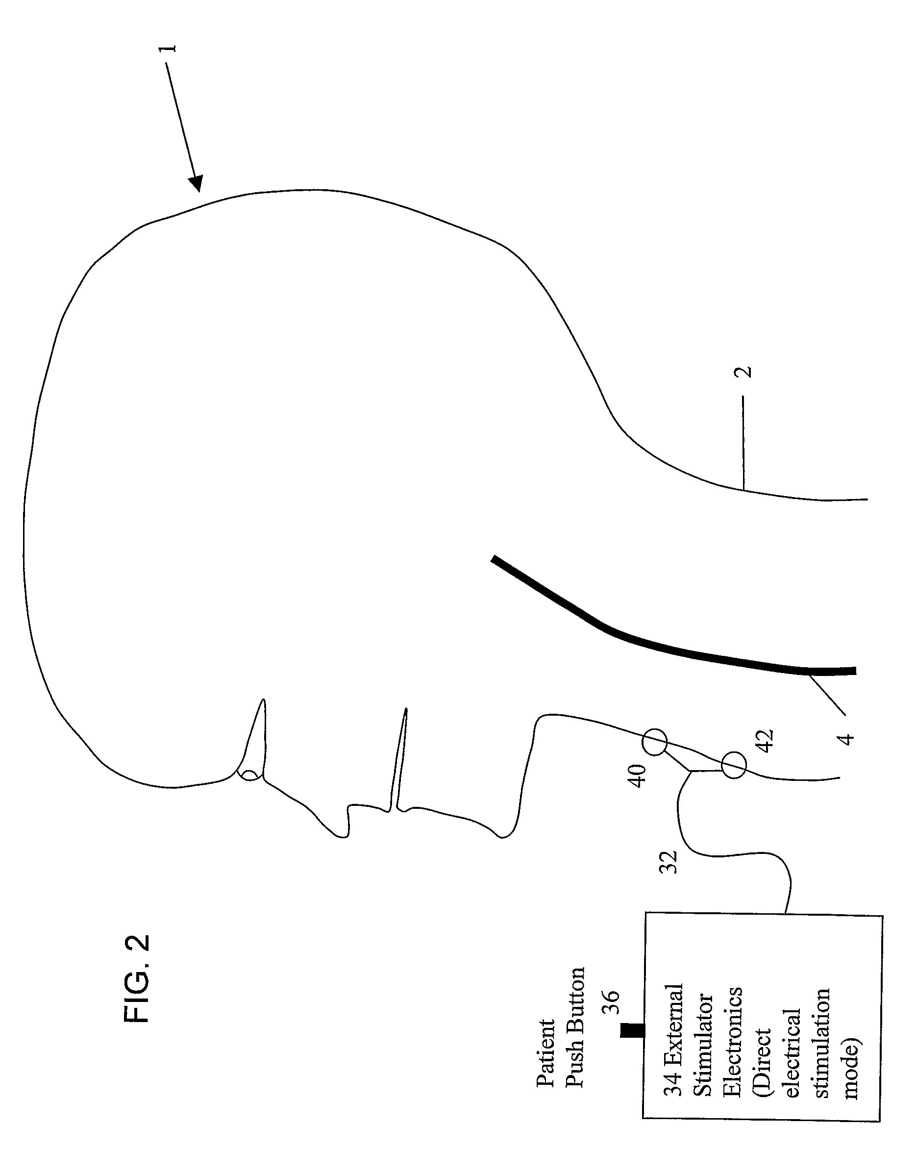 System and Method for Treating Nausea and Vomiting by Vagus Nerve Stimulation