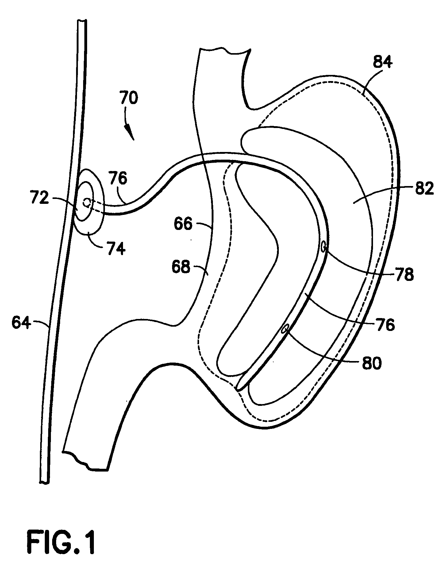 Gastro-occlusive device