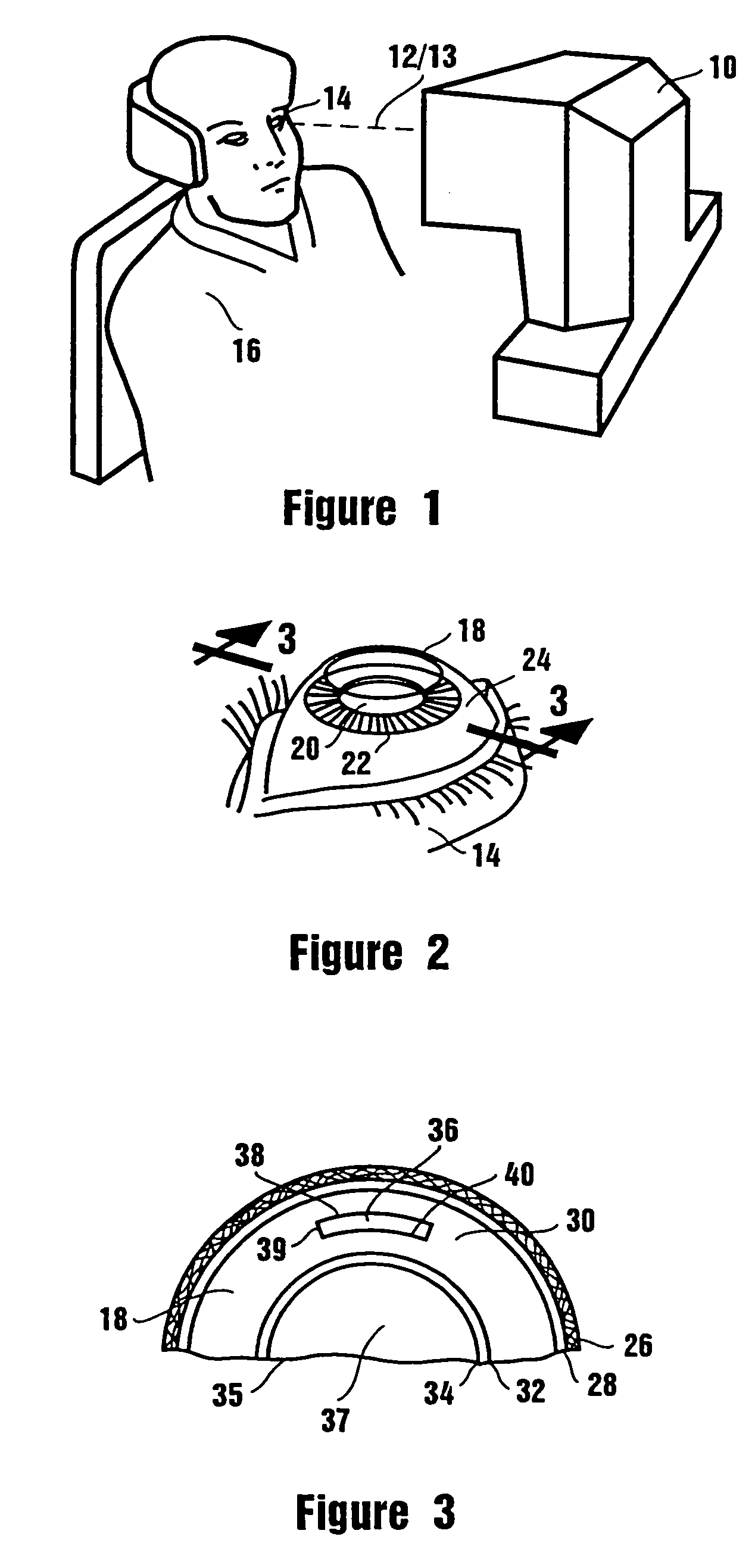 Method of corneal surgery by laser incising a contoured corneal flap