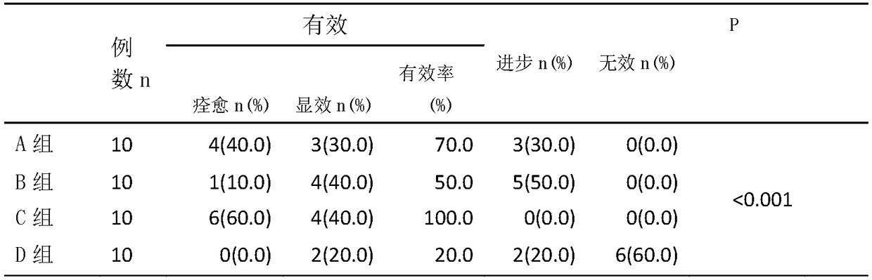 Application of preparation of pharmaceutical composition containing matrine and glycyrrhizic acid to treat psoriasis