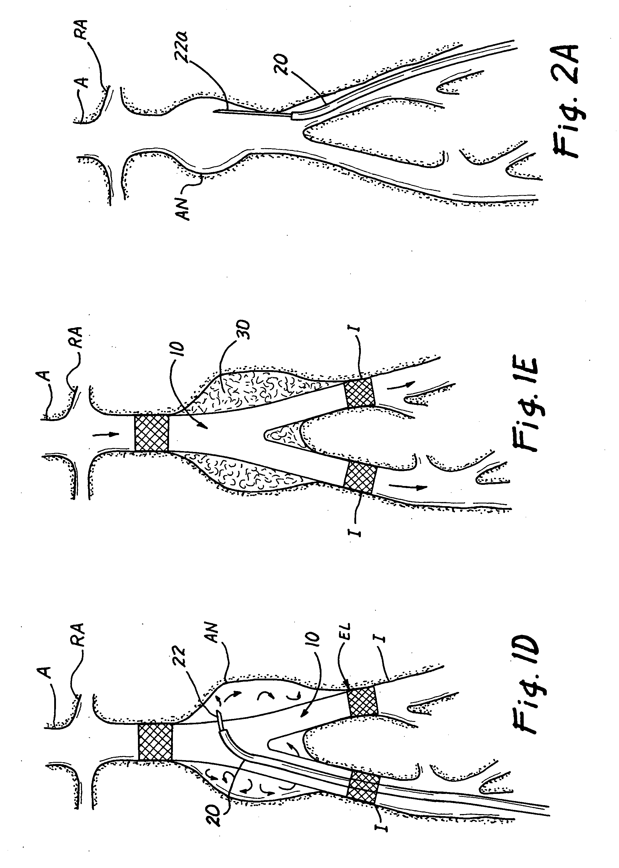 Methods, materials and apparatus for deterring or preventing endoleaks following endovascular graft implantation