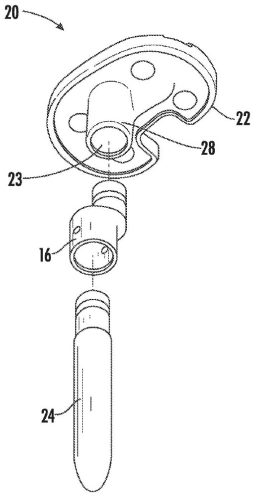 Orthopedic implant