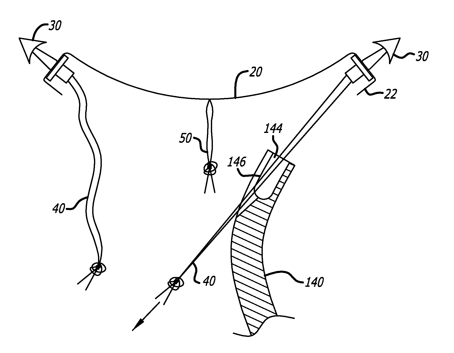Implants and procedures for supporting anatomical structures for treating conditions such as pelvic organ prolapse