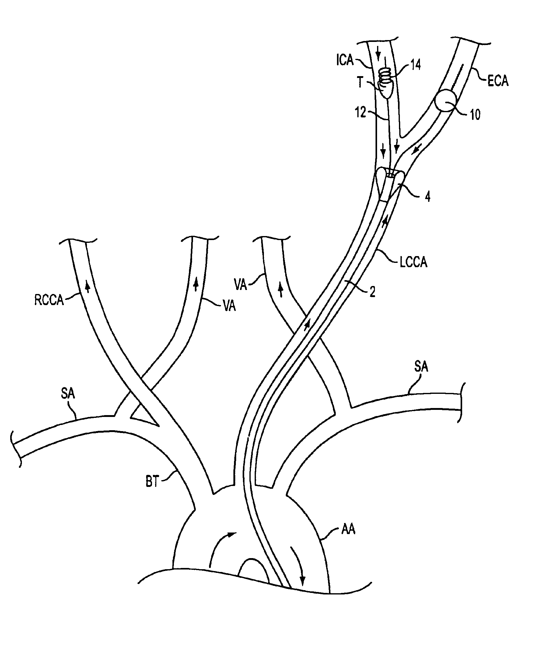 Apparatus and methods for treating stroke and controlling cerebral flow characteristics