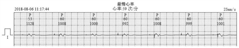 Novel display method of ECG waveform graph bar