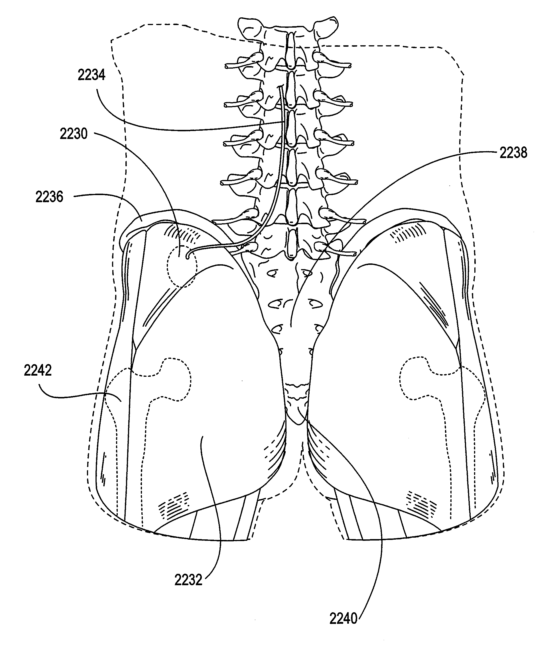 Devices, methods, and systems for harvesting energy in the body