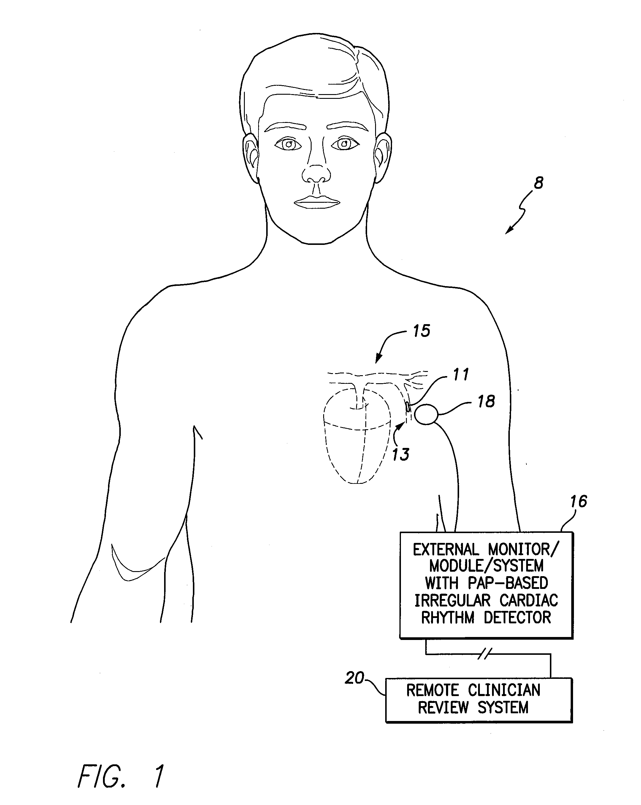 Systems and methods for exploiting pulmonary artery pressure obtained from an implantable sensor to detect cardiac rhythm irregularities