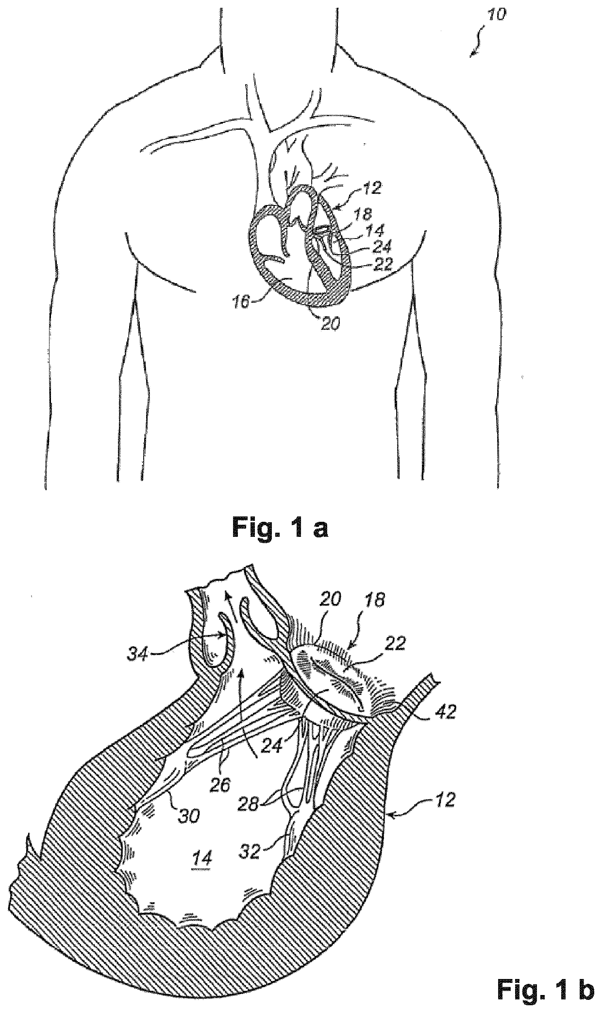 Device And Method For Improving Fixation Of A Medical Device