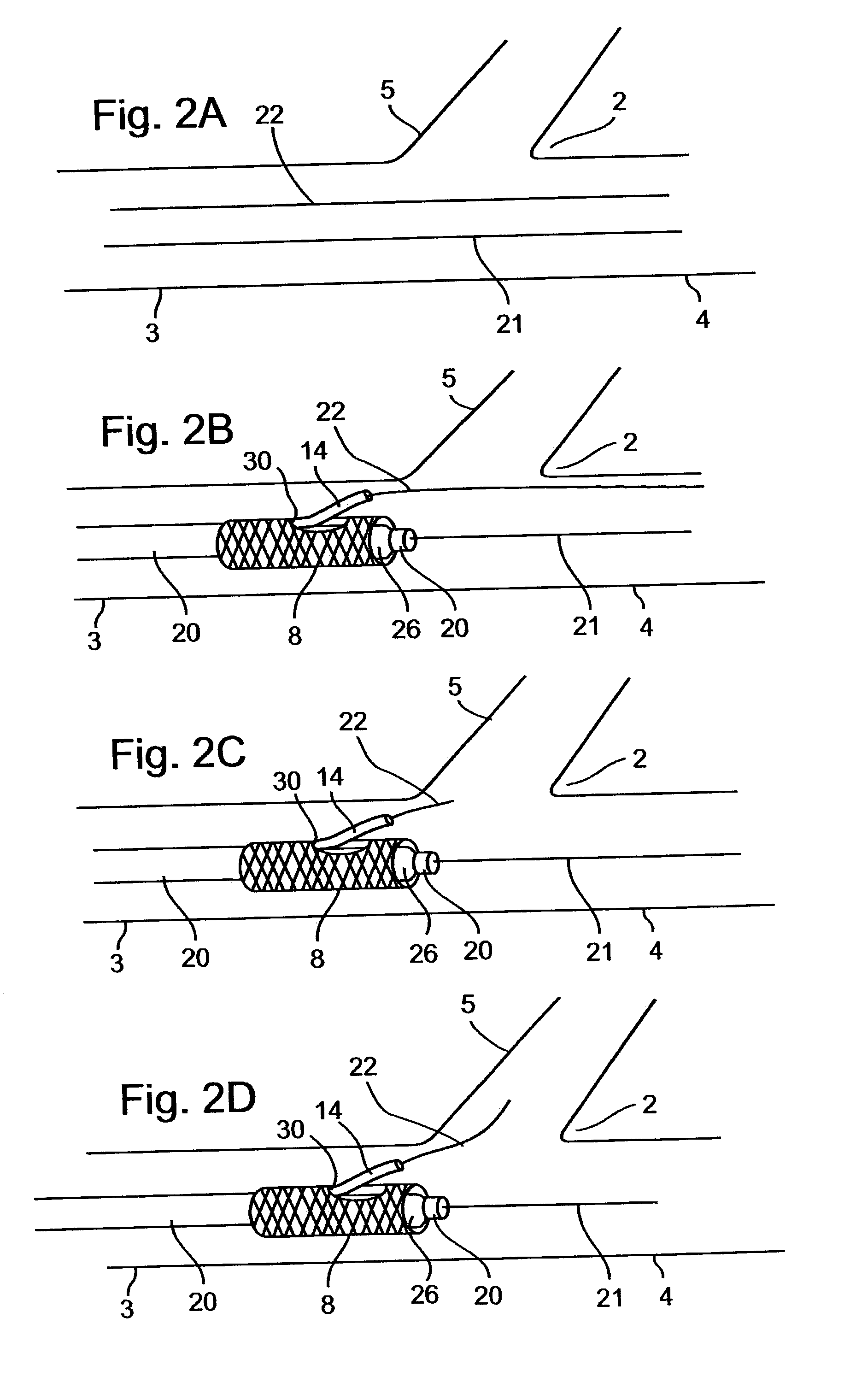 Methods for deploying stents in bifurcations