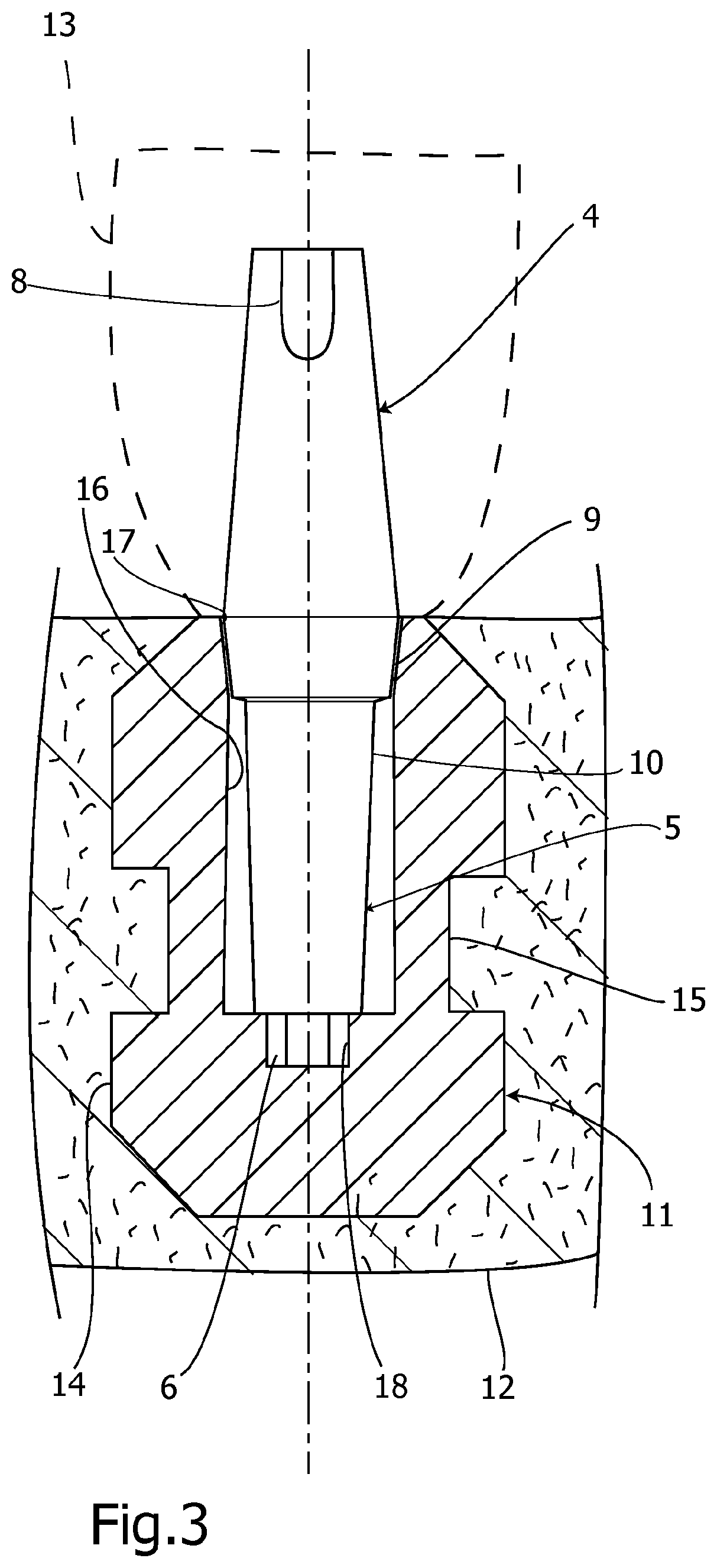 Dental implant system