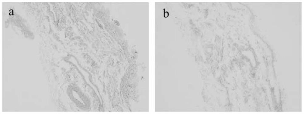 Decellularized small intestinal submucosa/polylactic acid-glycolic acid copolymer composite scaffold as well as preparation method and application thereof