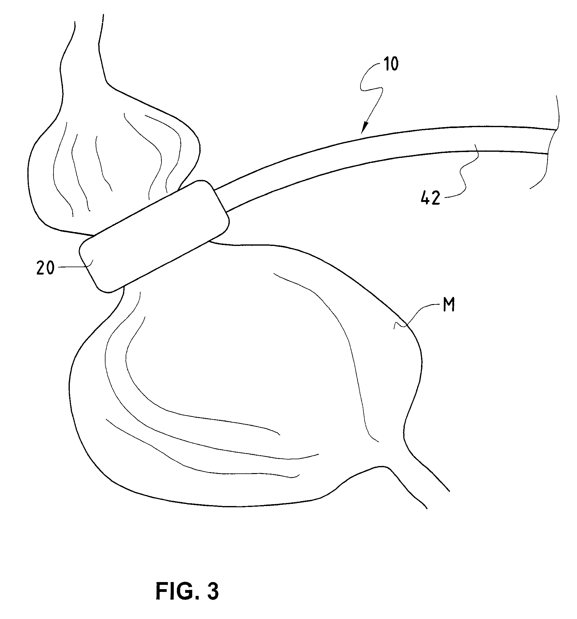 Adaptive device and adaptive method for automatically adapting the stomach opening of a patient