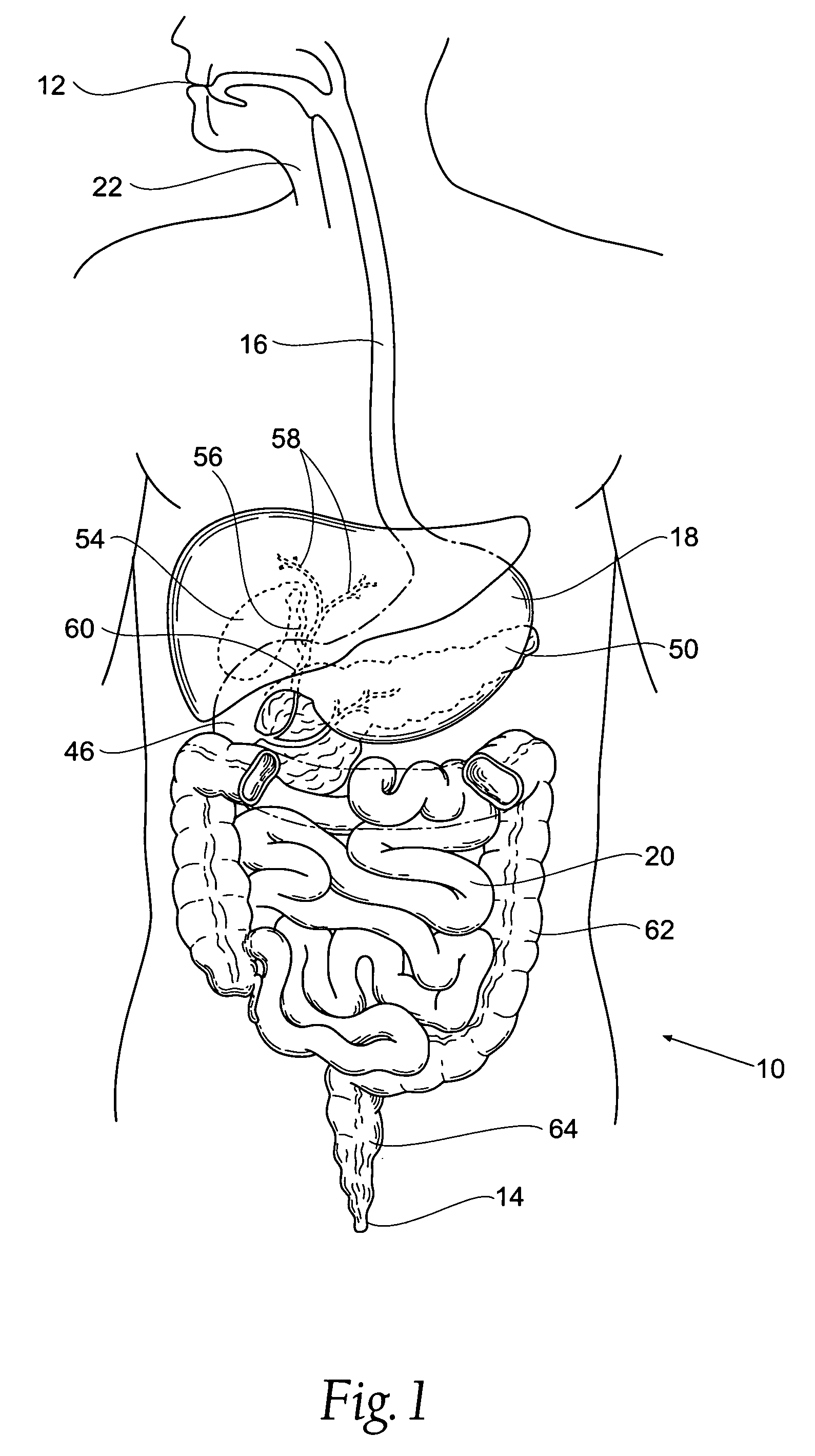 Systems and methods for treating obesity and other gastrointestinal conditions