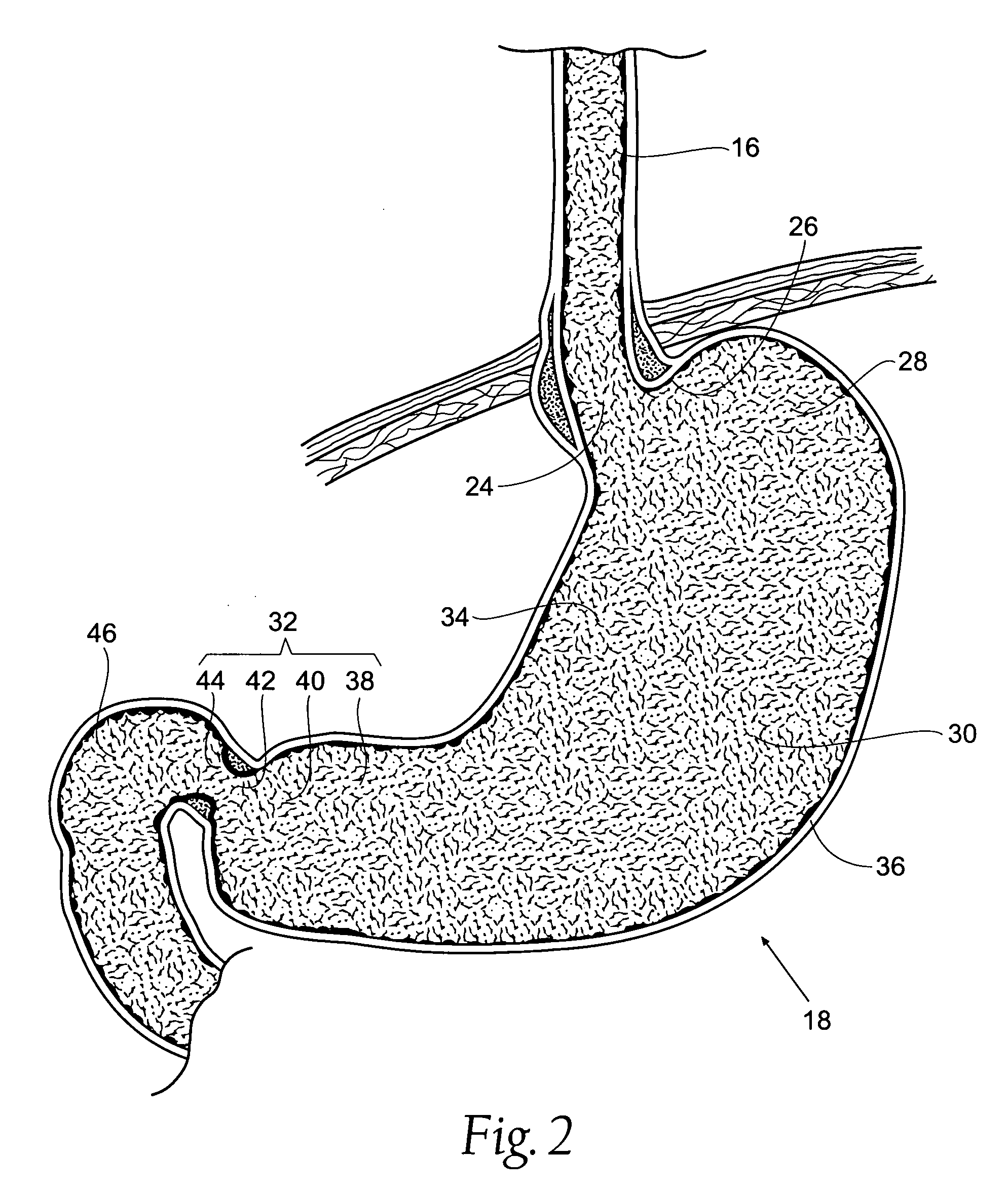Systems and methods for treating obesity and other gastrointestinal conditions