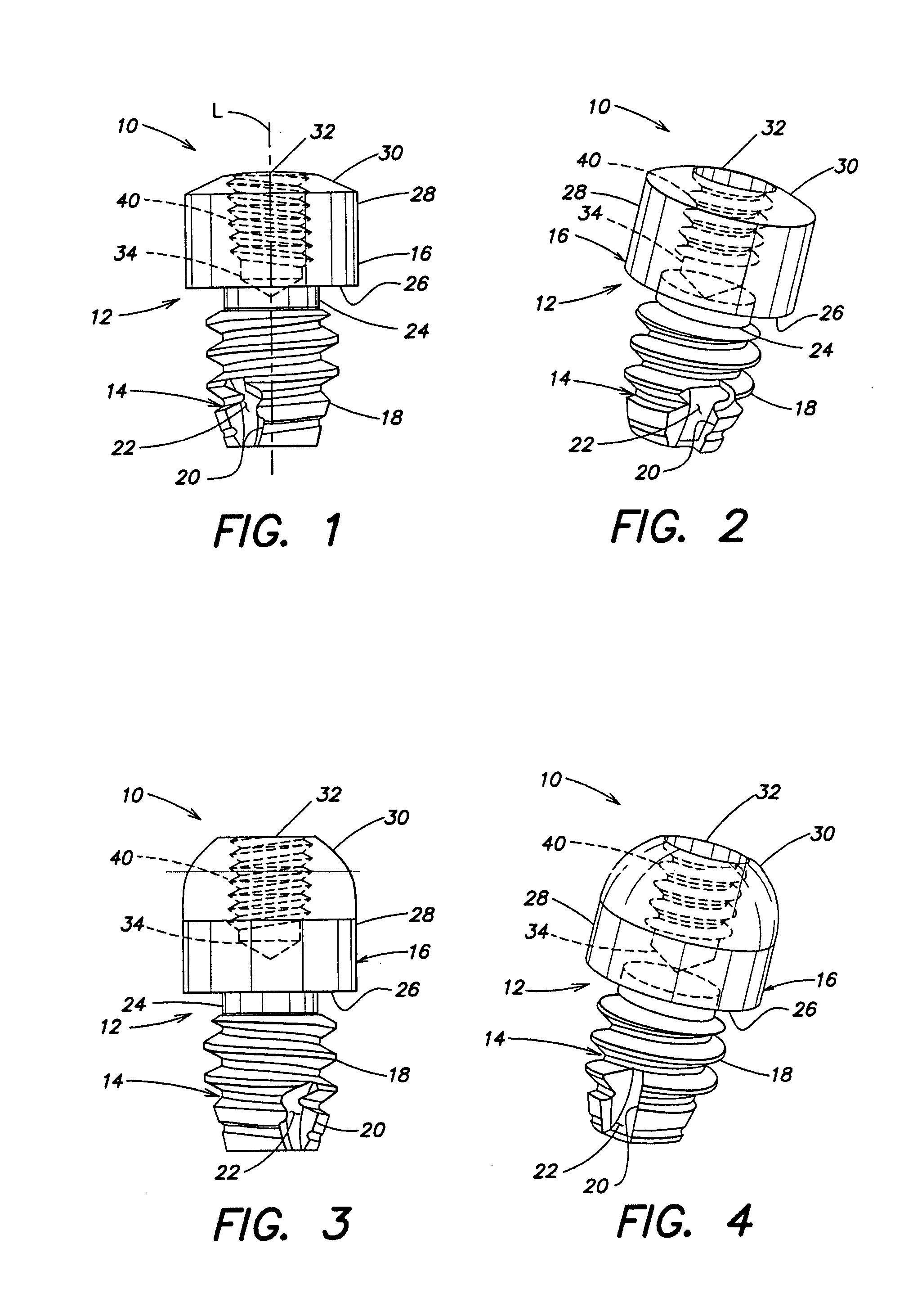 Dental implant for supporting a dental prosthesis