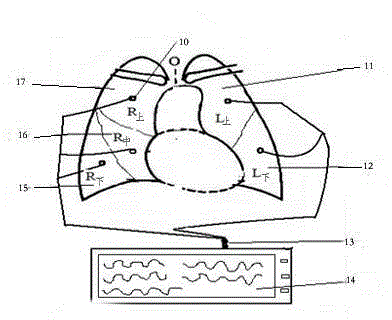 Lung lobe breath sound monitoring and automatic analyzing device