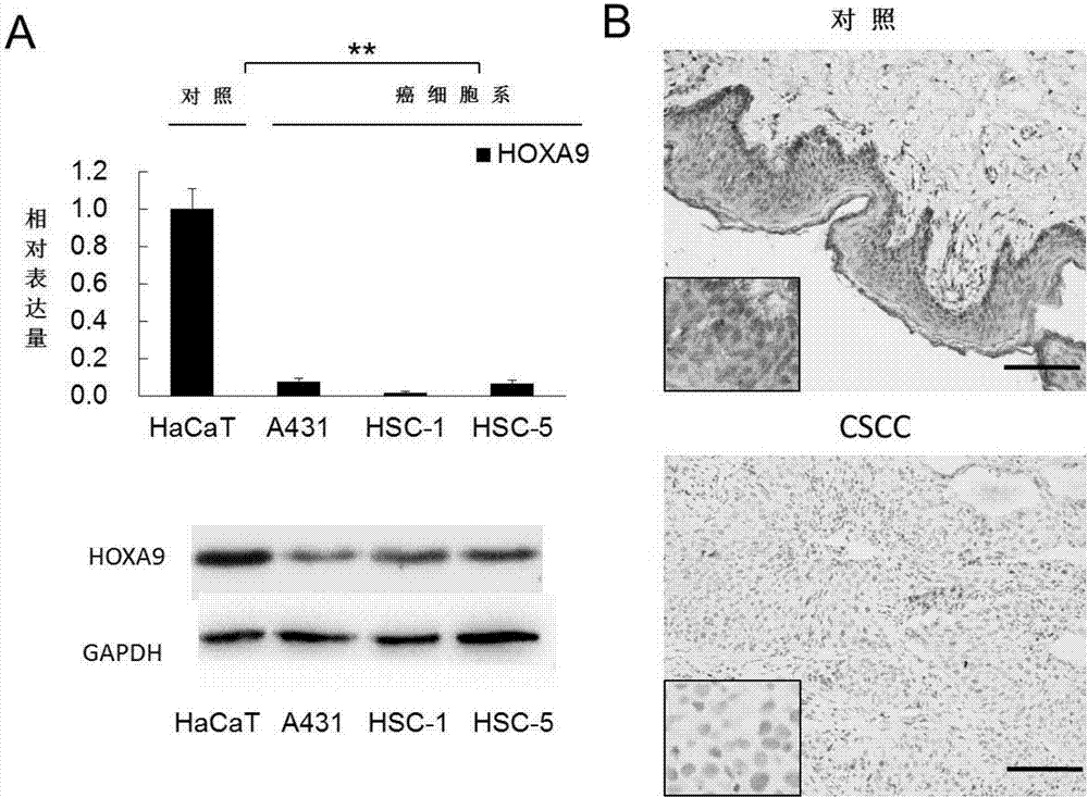 Application of HOXA9 gene in preparation of drugs for treatment of cutaneous squamous cell carcinoma