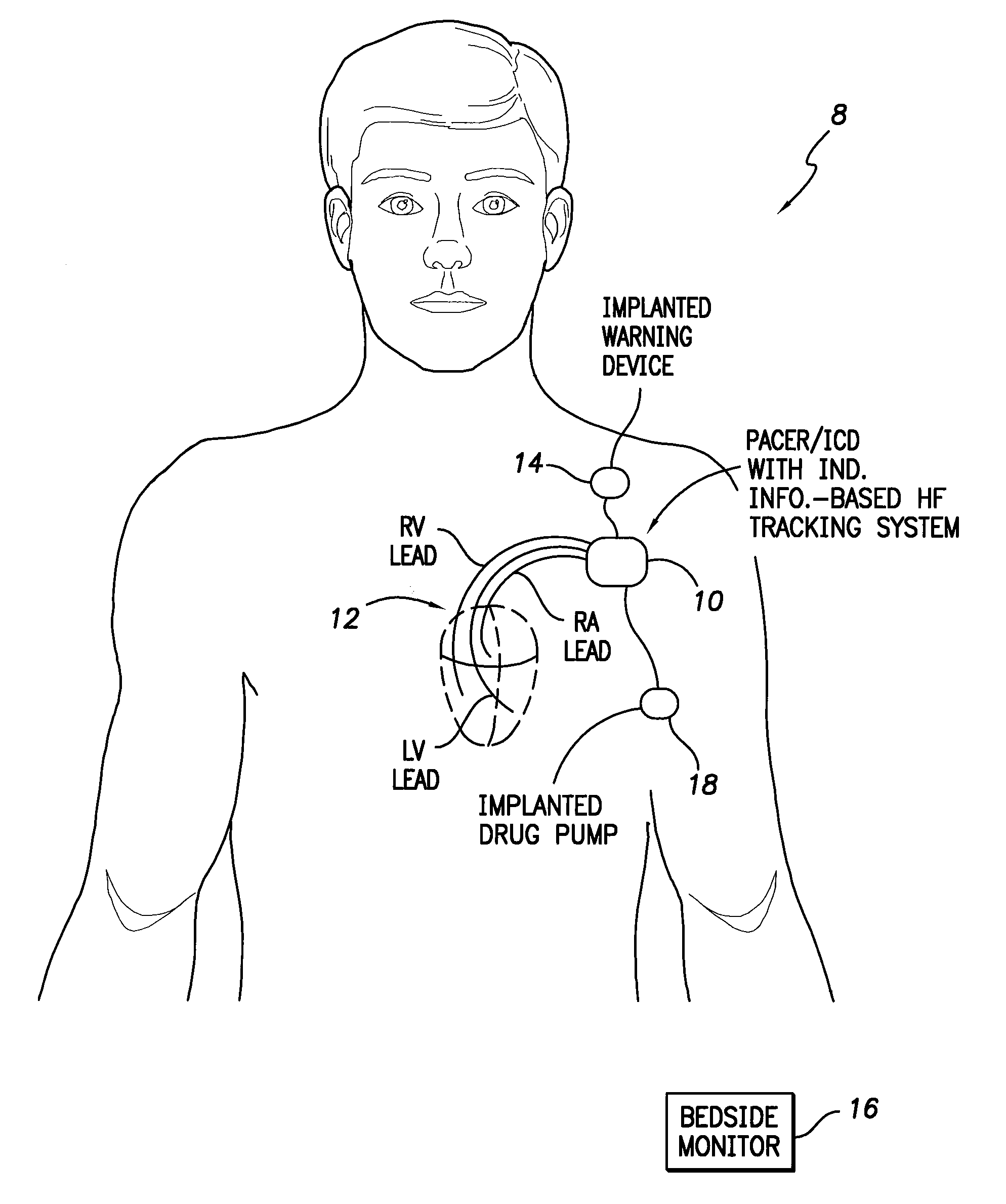 Systems and methods for use by an implantable medical device for detecting heart failure based on the independent information content of immittance vectors