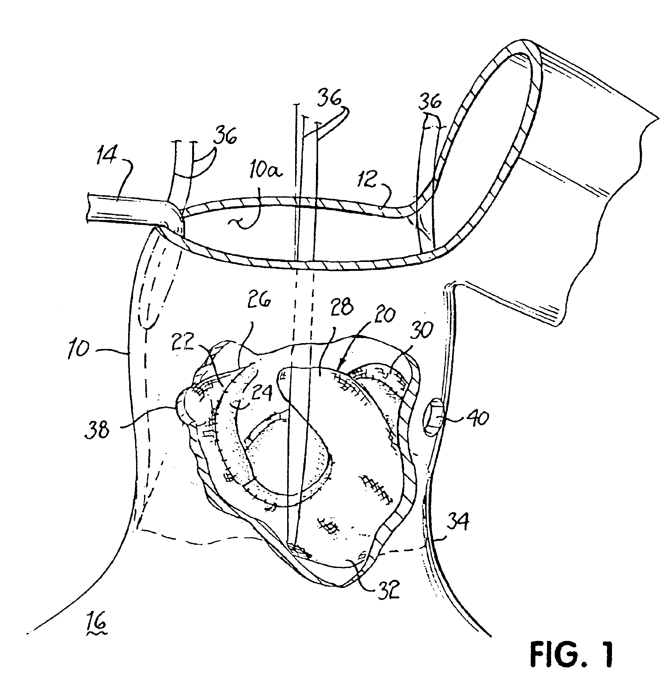 Heart valve and apparatus for replacement thereof