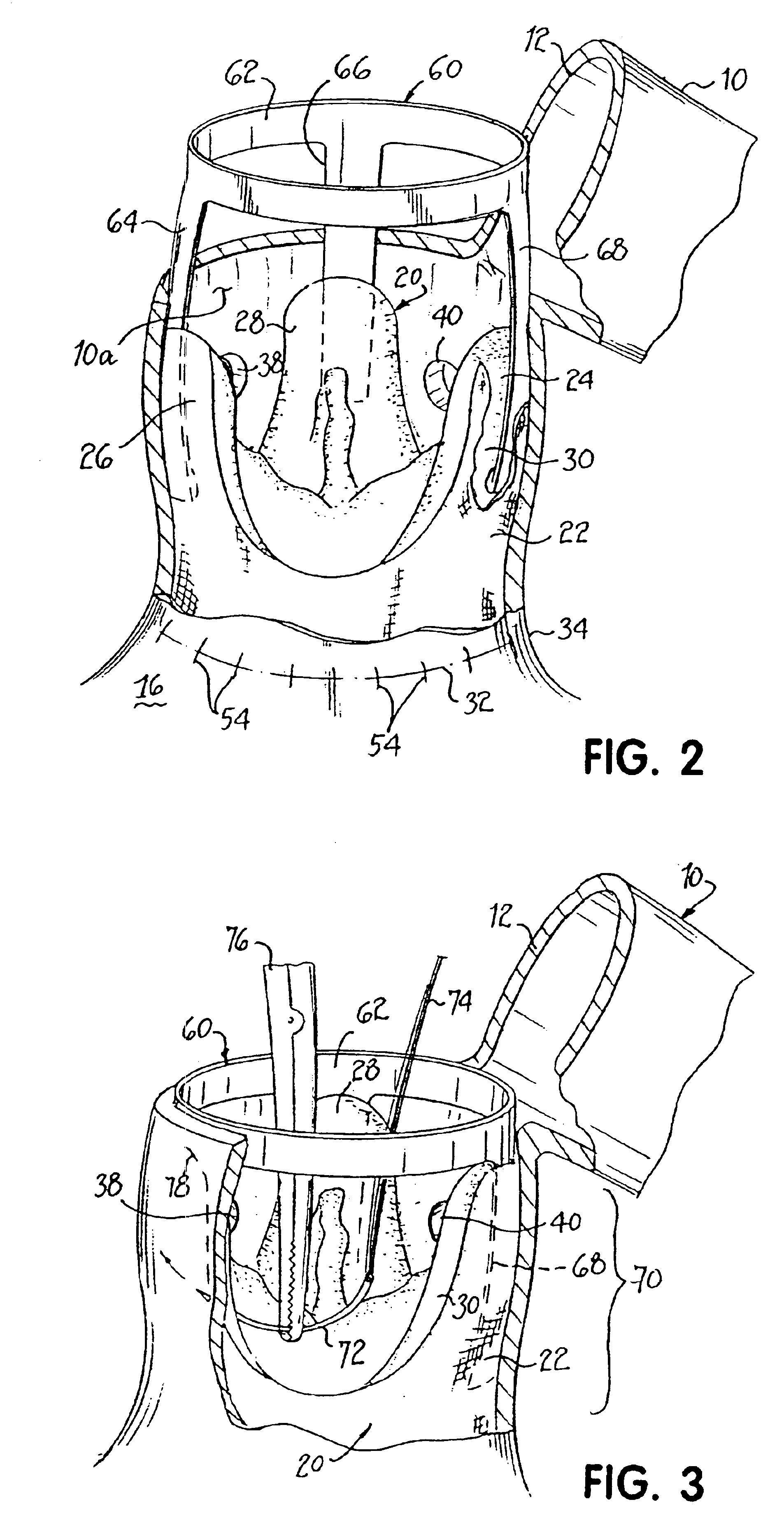Heart valve and apparatus for replacement thereof