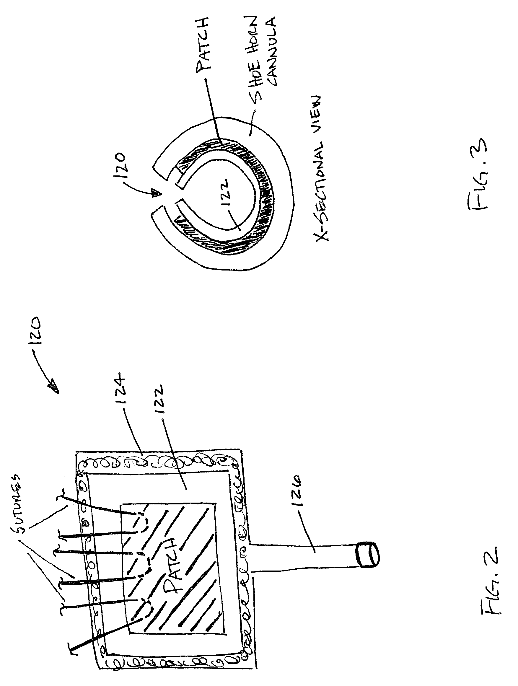Rotator cuff patch delivery device