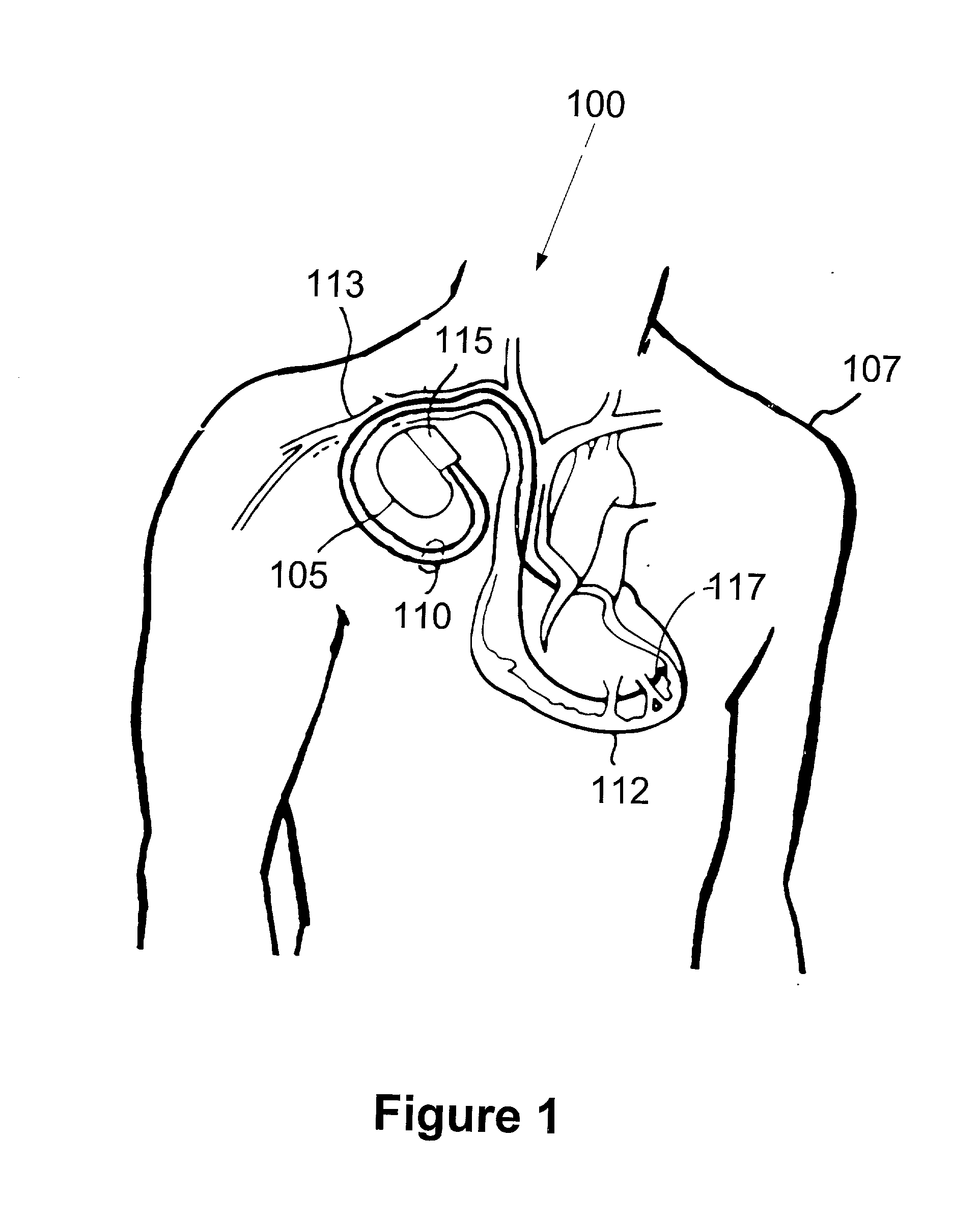 Method and apparatus for controlling an implantable medical device in response to the presence of a magnetic field and/or high frequency radiation interference signals