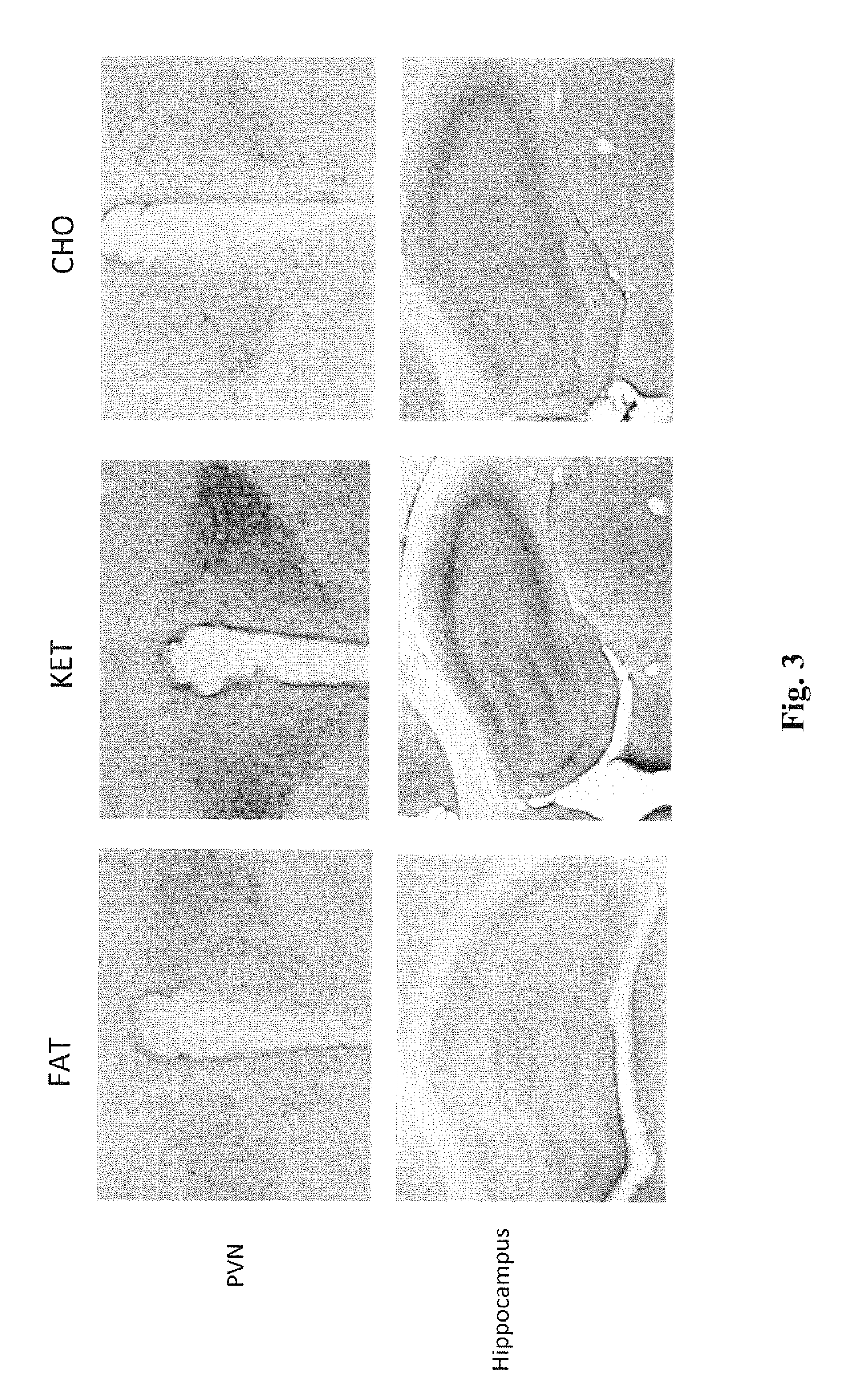 Hydroxybutyrate ester and medical use thereof