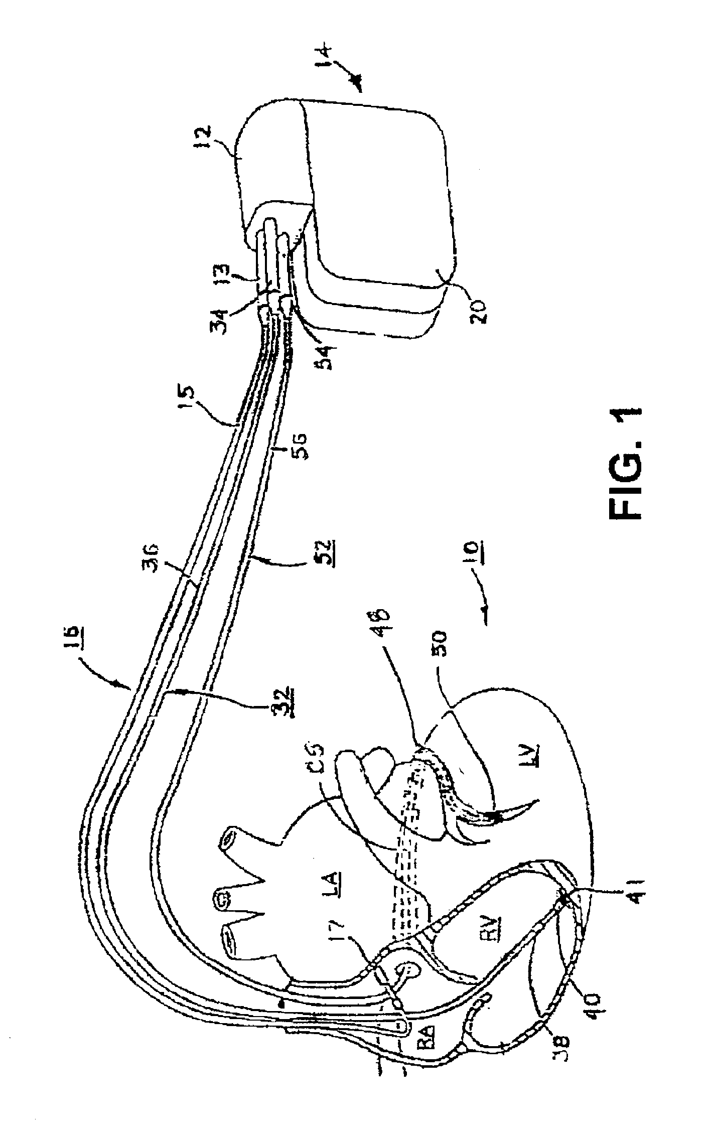 Method and apparatus for optimizing cardiac resynchronization therapy