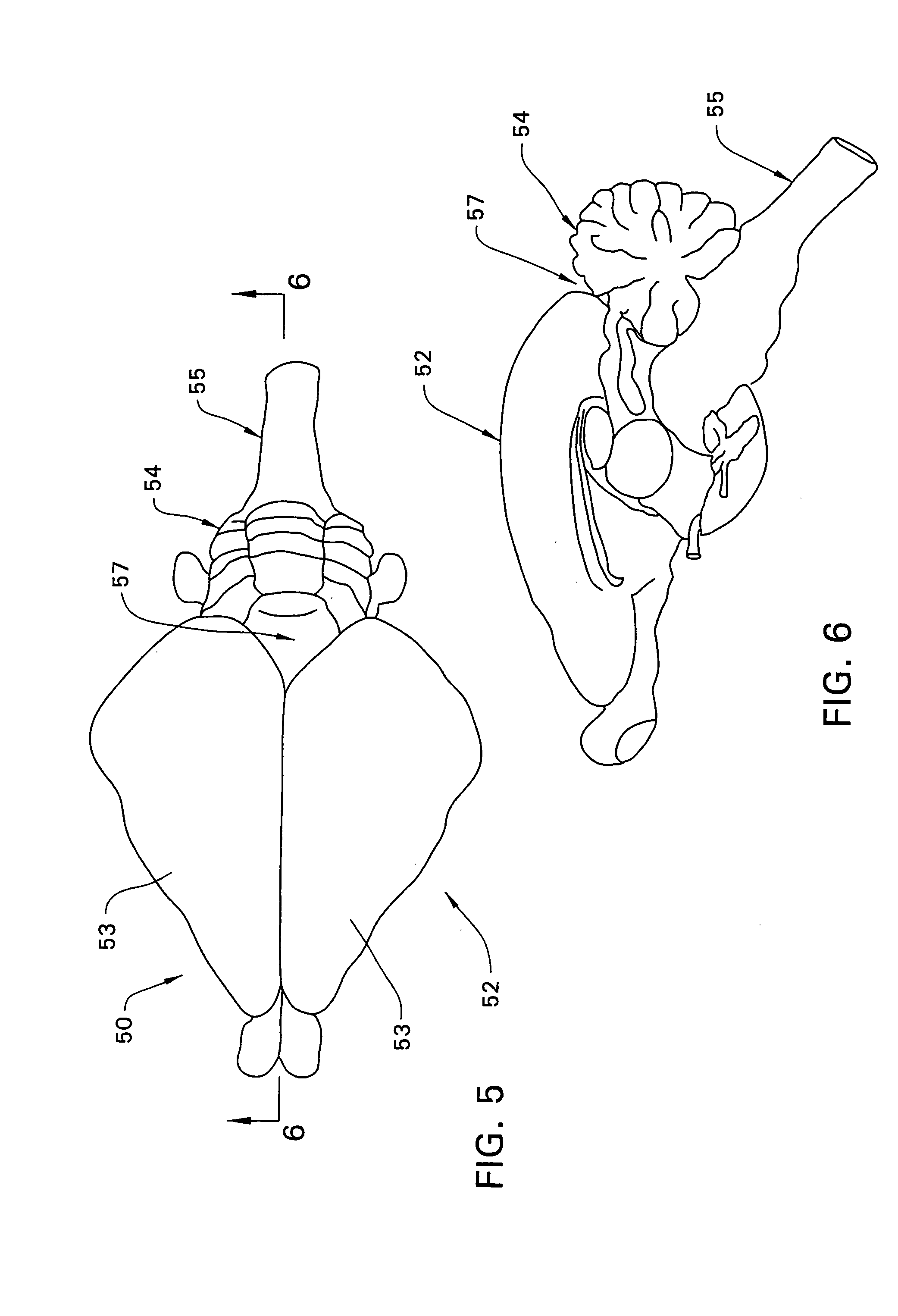 Surgical implant and method of accessing cerebrospinal fluid