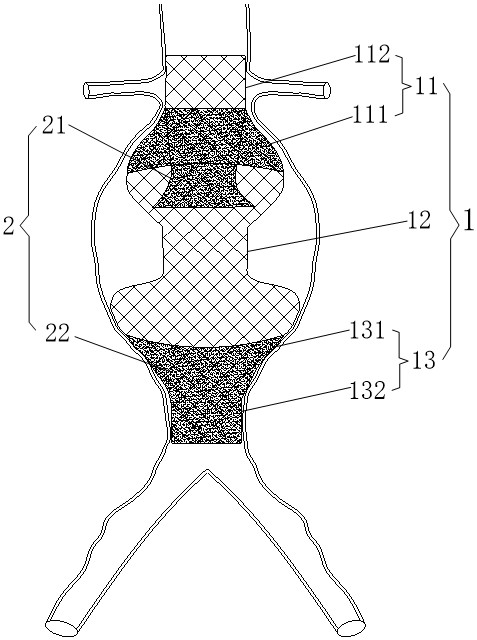 Stent anchoring area moving down device