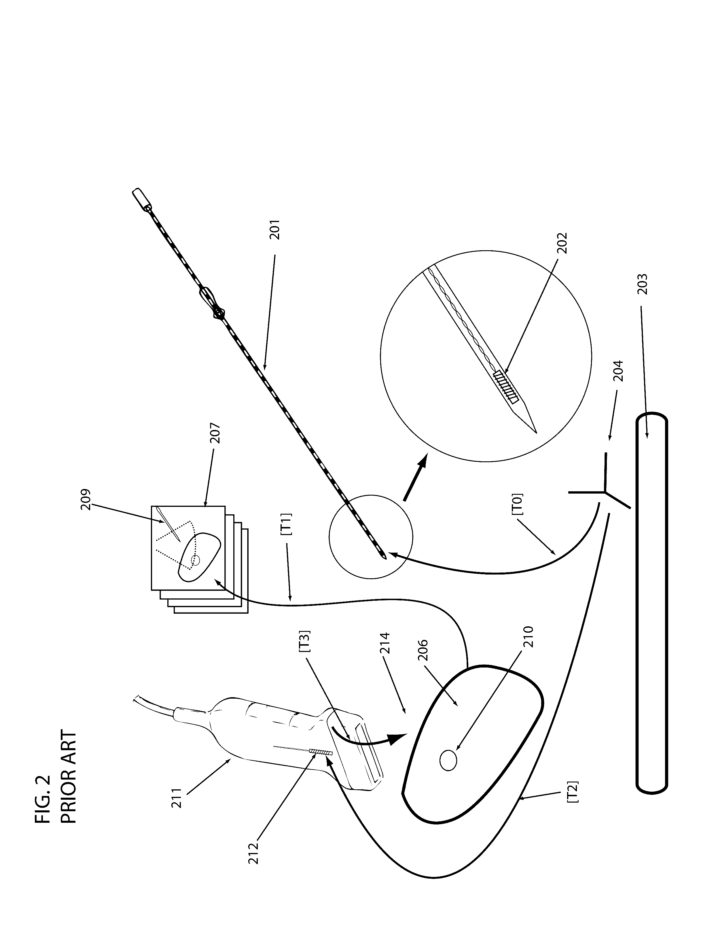 Systems, methods, and devices for assisting or performing guided interventional procedures using custom templates
