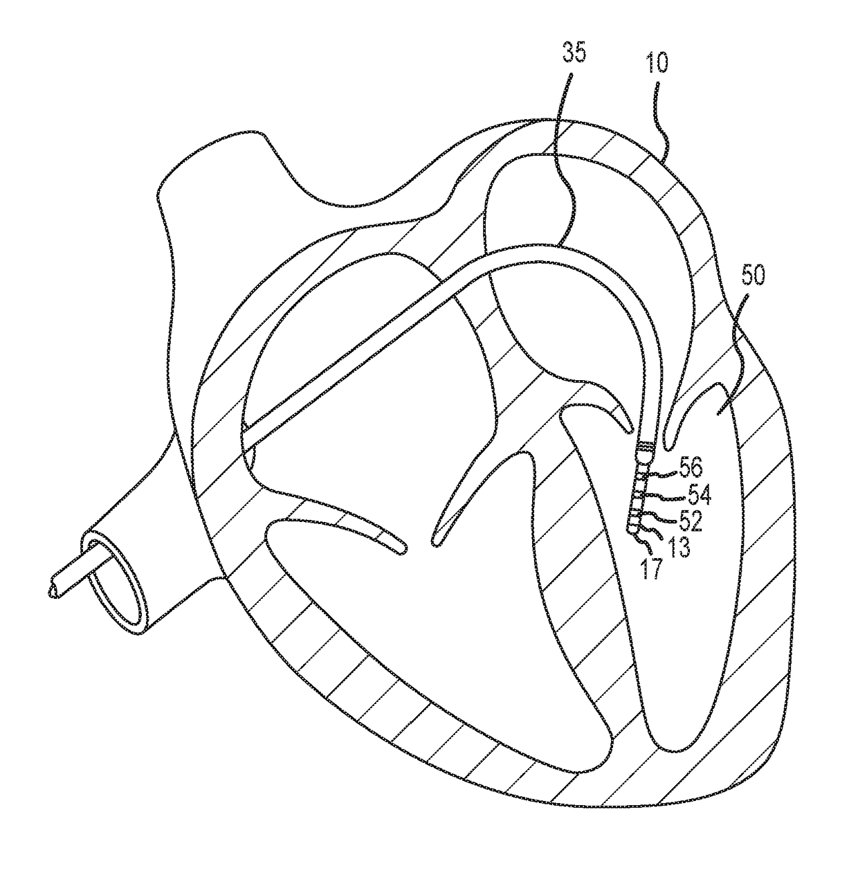 Methods and Systems for Statistically Analyzing Electrograms for Local Abnormal Ventricular Activities and Mapping the Same