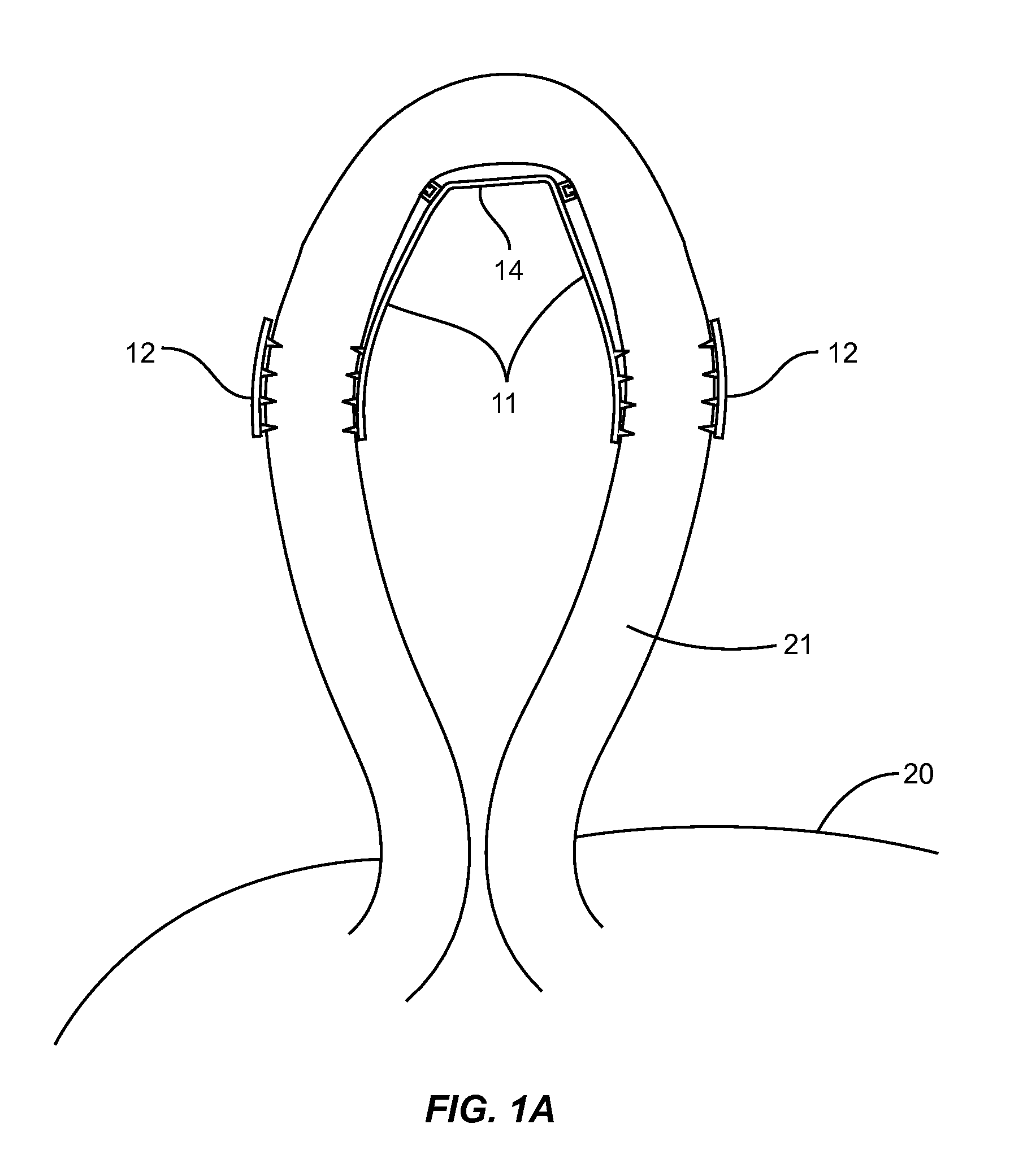 Vas deferens vasectomy capping device