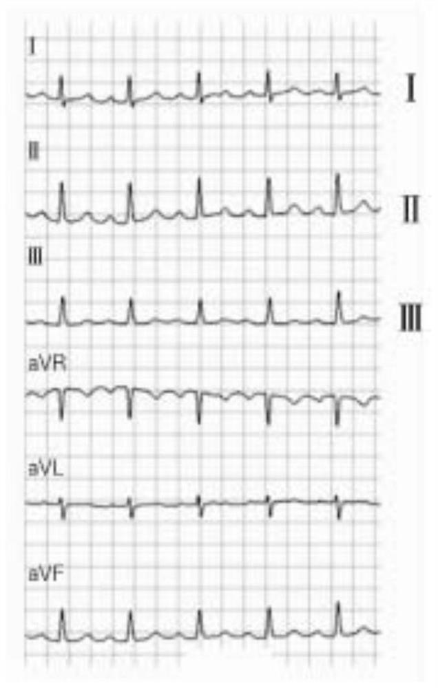 Electrocardiosignal monitoring method, monitoring device and storage medium