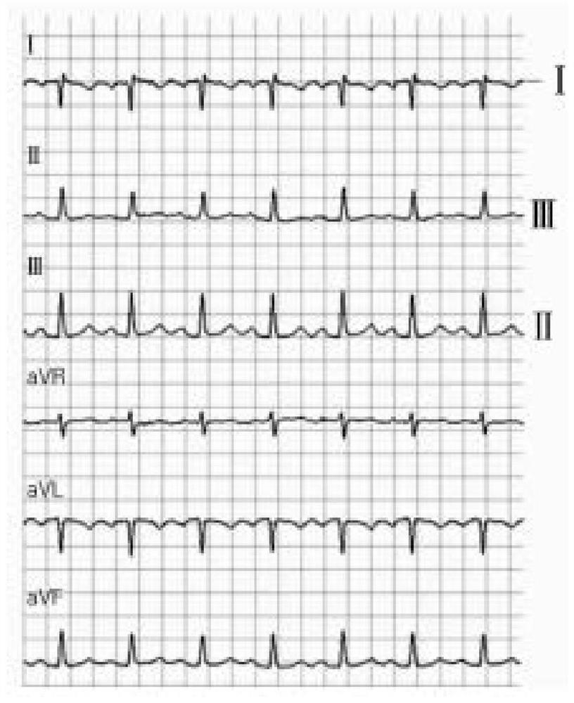 Electrocardiosignal monitoring method, monitoring device and storage medium