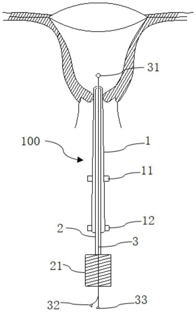 Uterus salpingography tube