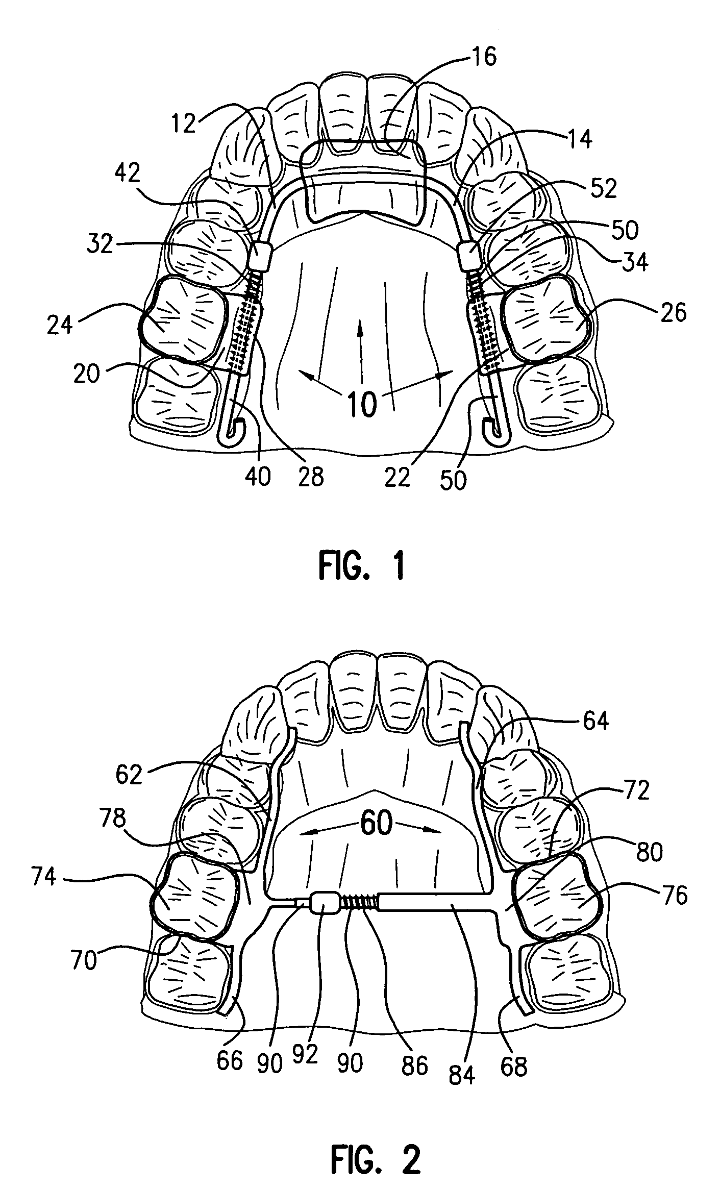 Self-locking power component for orthodontic appliances