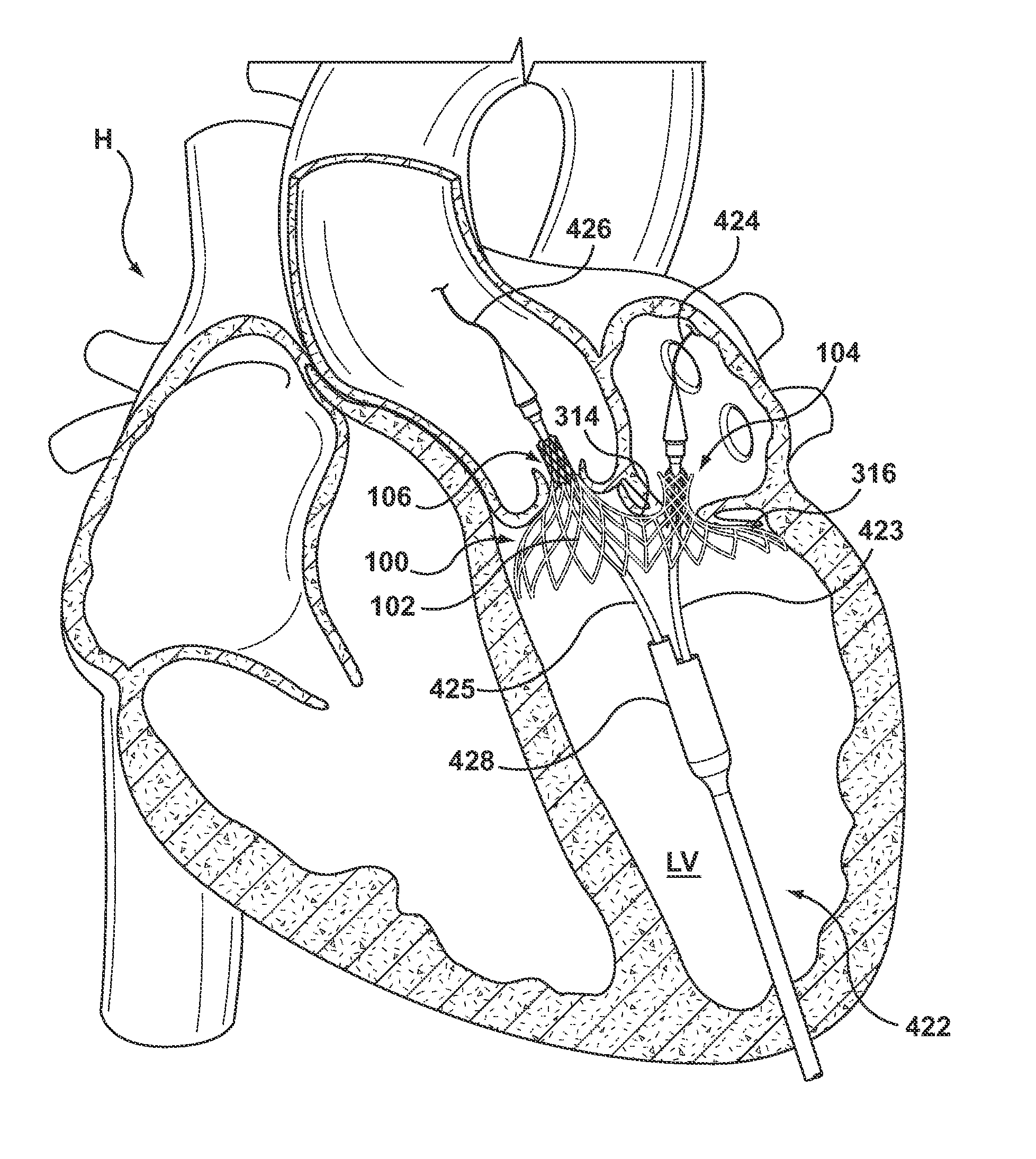 Dual Valve Prosthesis for Transcatheter Valve Implantation