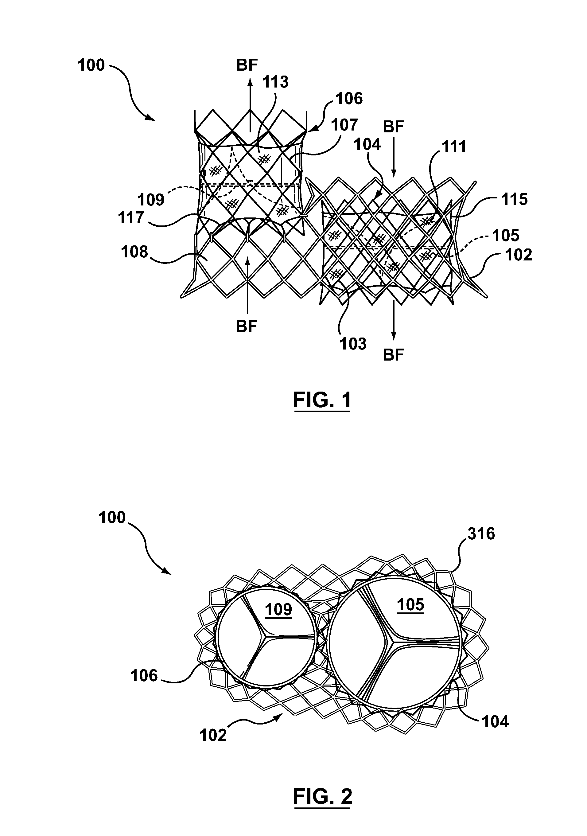 Dual Valve Prosthesis for Transcatheter Valve Implantation