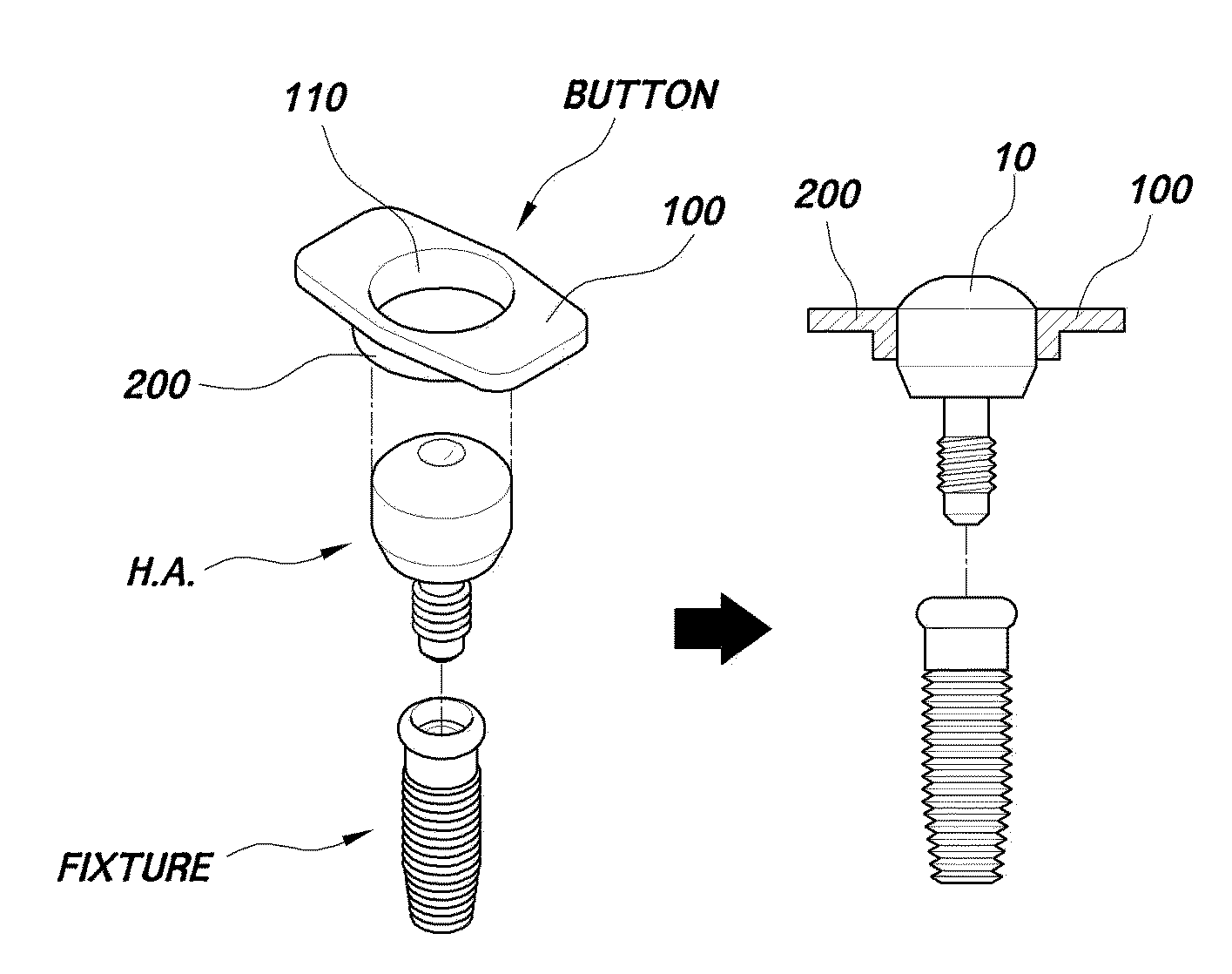 Button for implnat healing abutment and implant healing abutment having pressing part