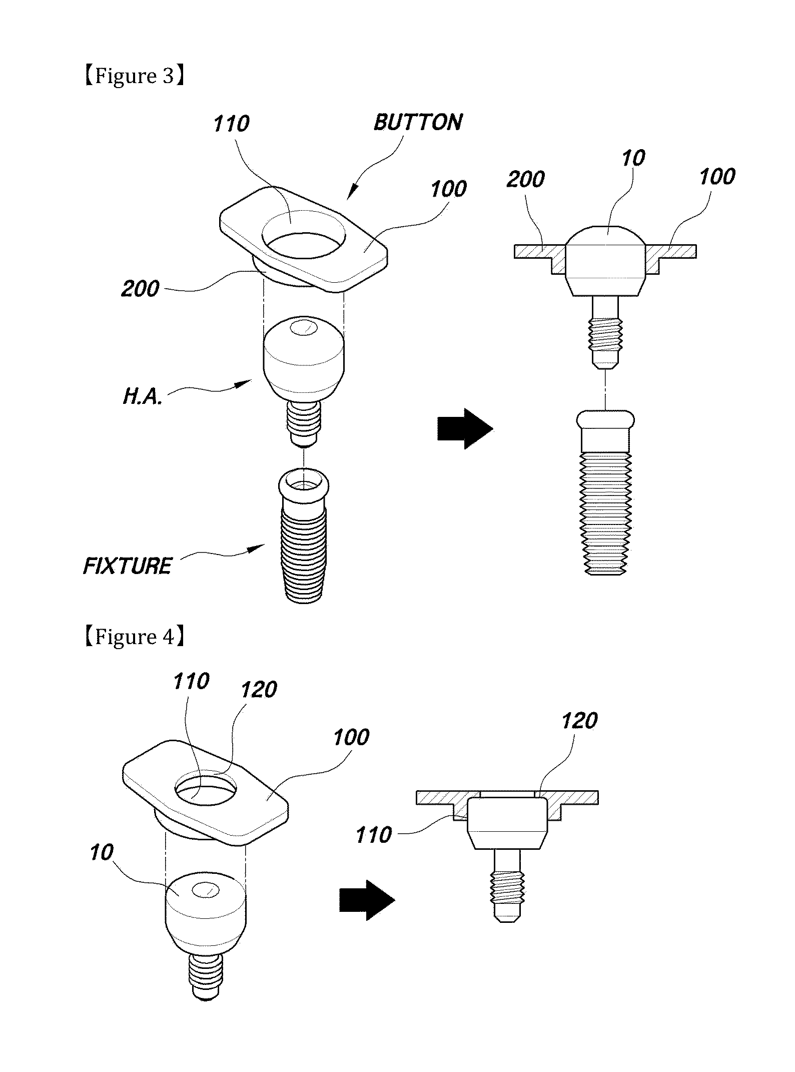 Button for implnat healing abutment and implant healing abutment having pressing part